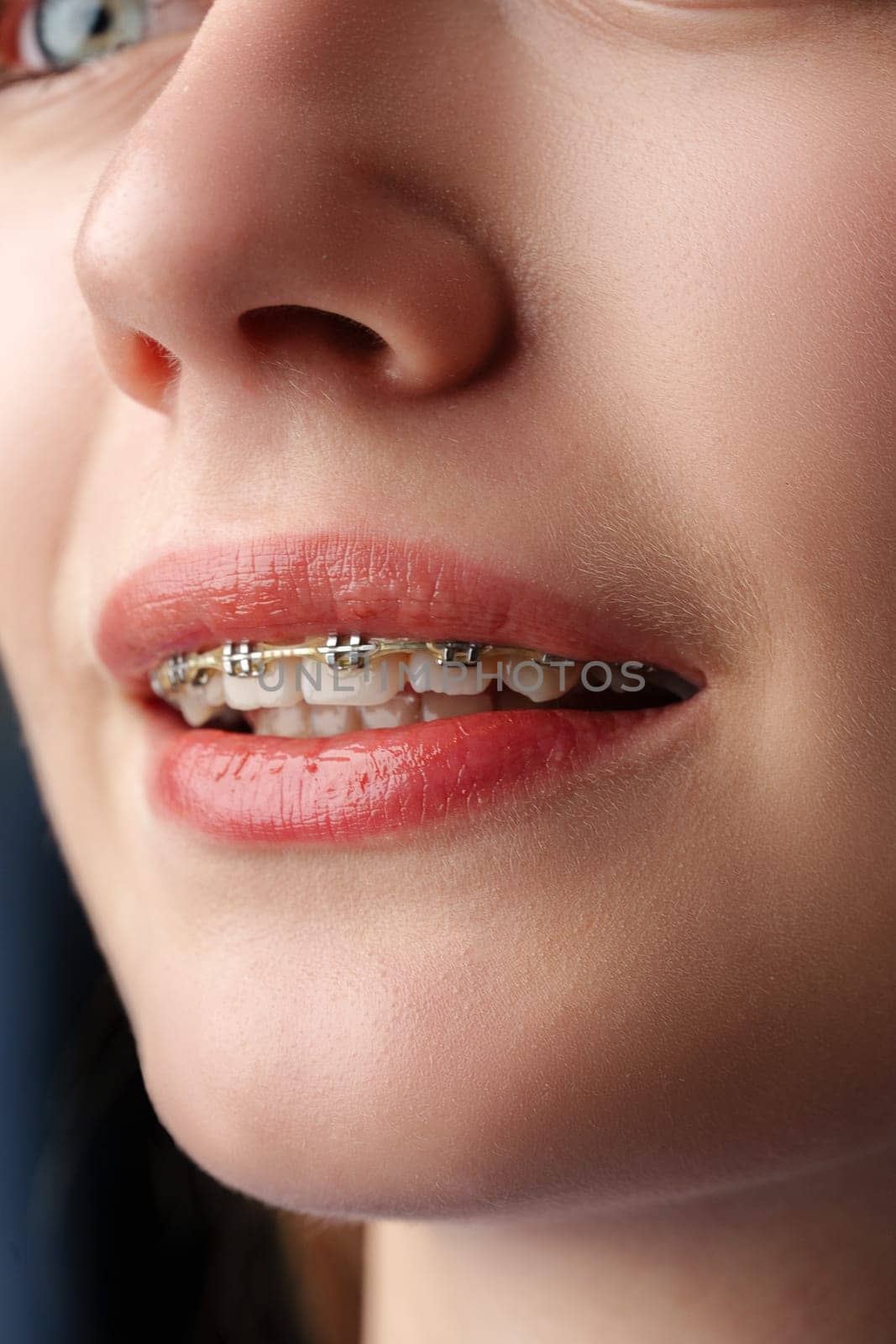 Young woman with dental braces close up photo