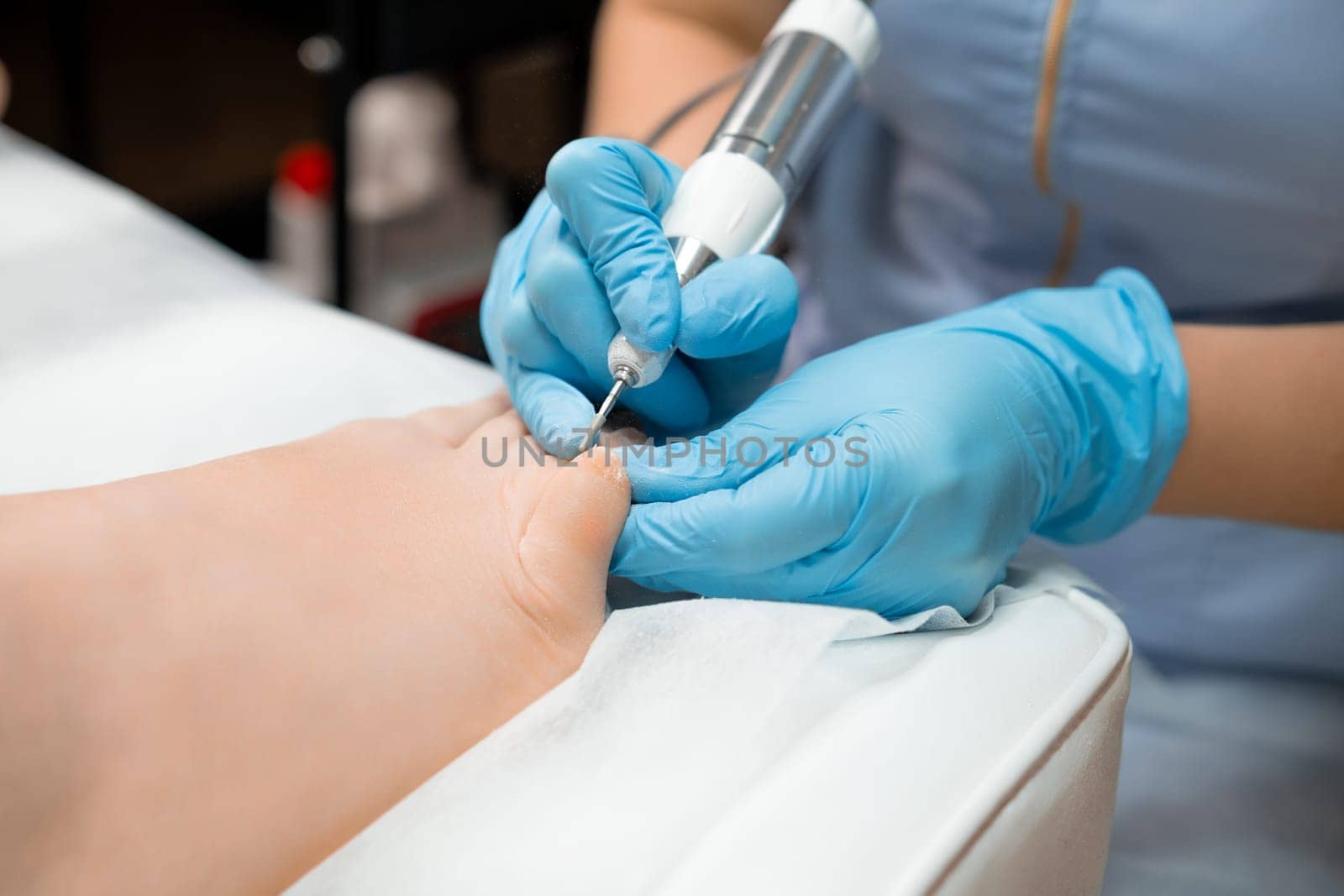 Medical pedicure. Podologist treats the toe nail with a milling machine