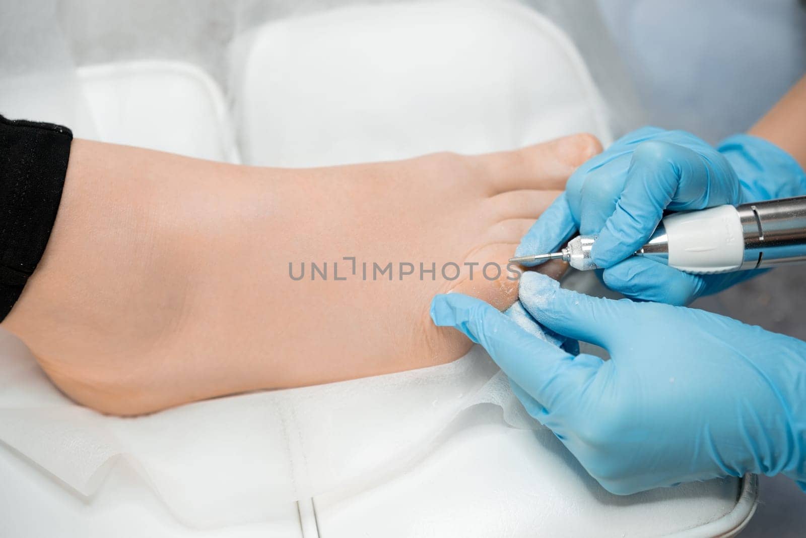 A medical pedicure session involves a podiatrist treating the toenail using a milling machine.