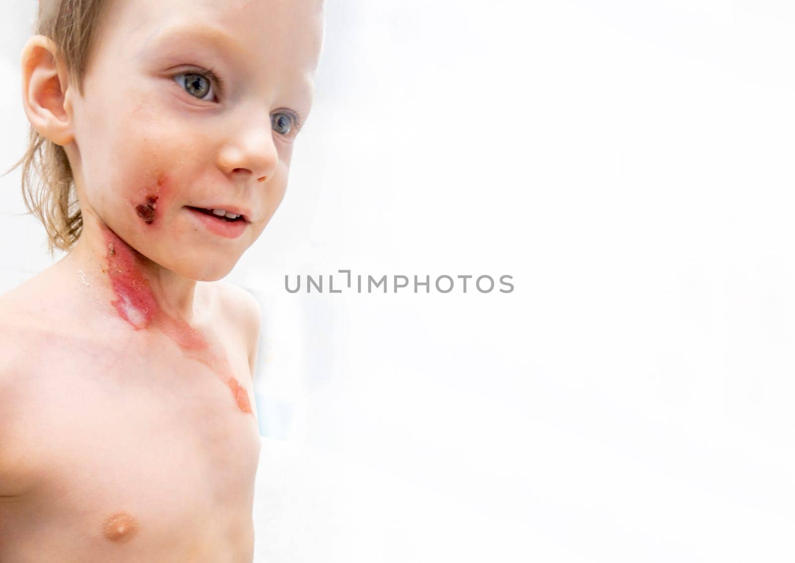 medical procedure dressing a boy with a first-degree burn from boiling water on his face, neck and chest