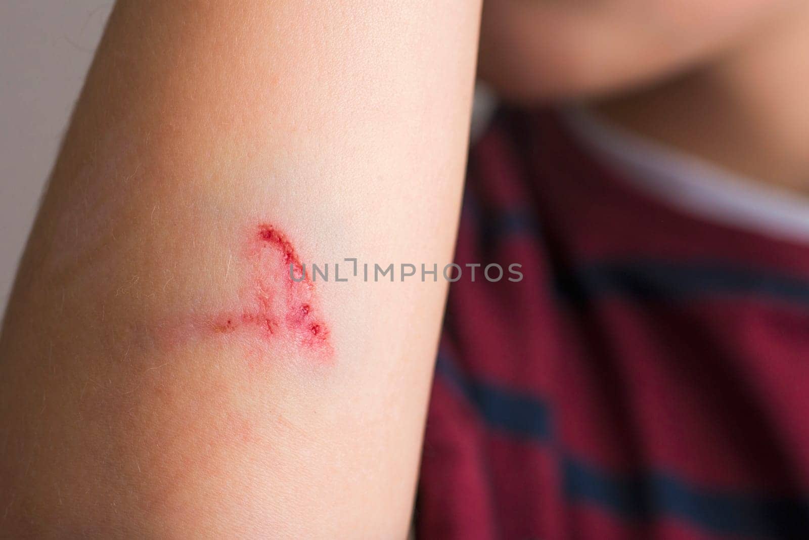 Close-Up of a Child's Arm with a Scratch. by andreyz