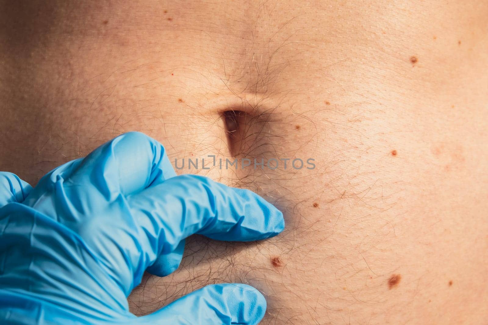 Doctor in medical gloves examining man skin mole. Dermatologist checking male birthmarks. Self care preventing cancer procedure. Protection treatment skin positivity by anna_stasiia