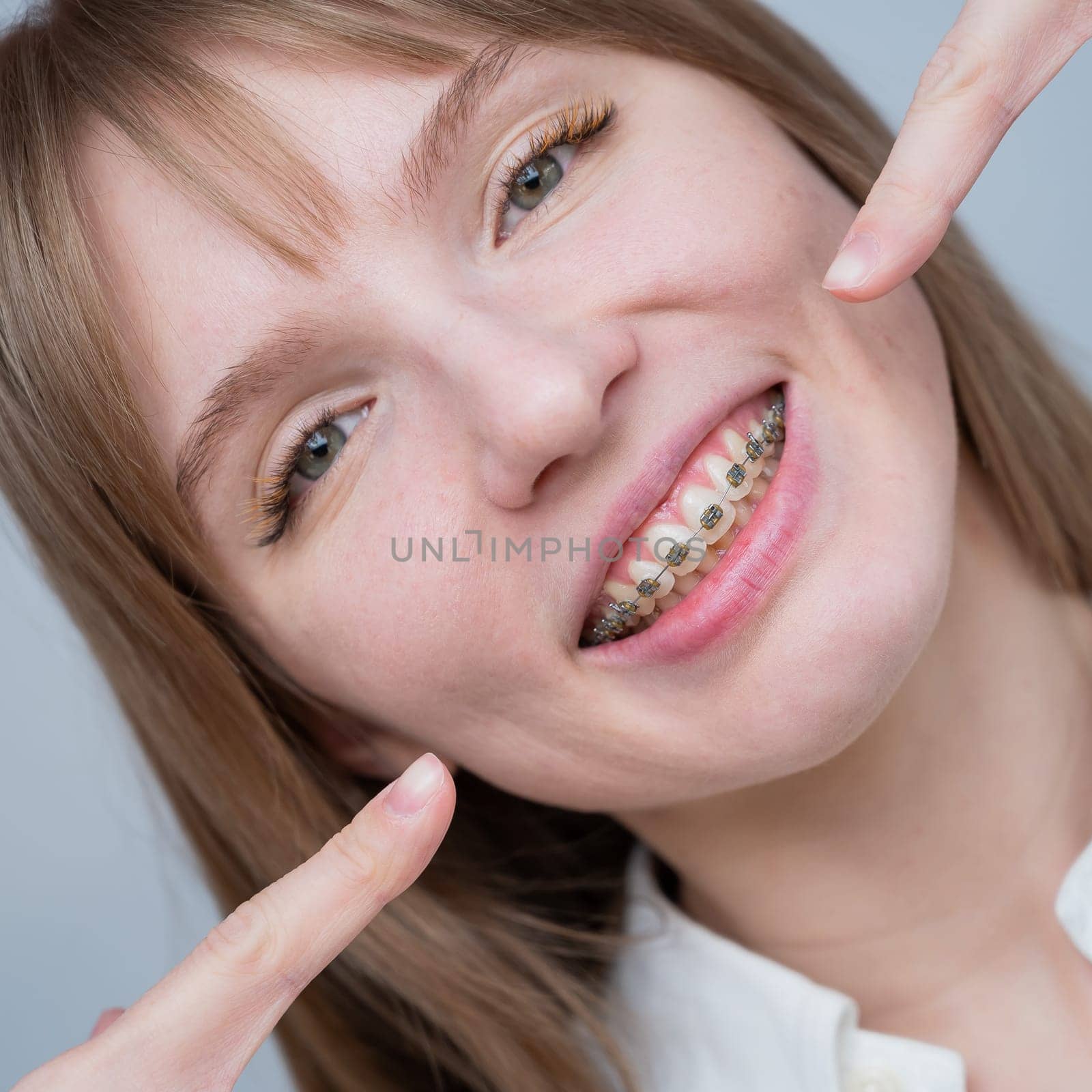 A beautiful red-haired girl smiles and points to the braces. Young woman corrects bite with orthodontic appliance by mrwed54