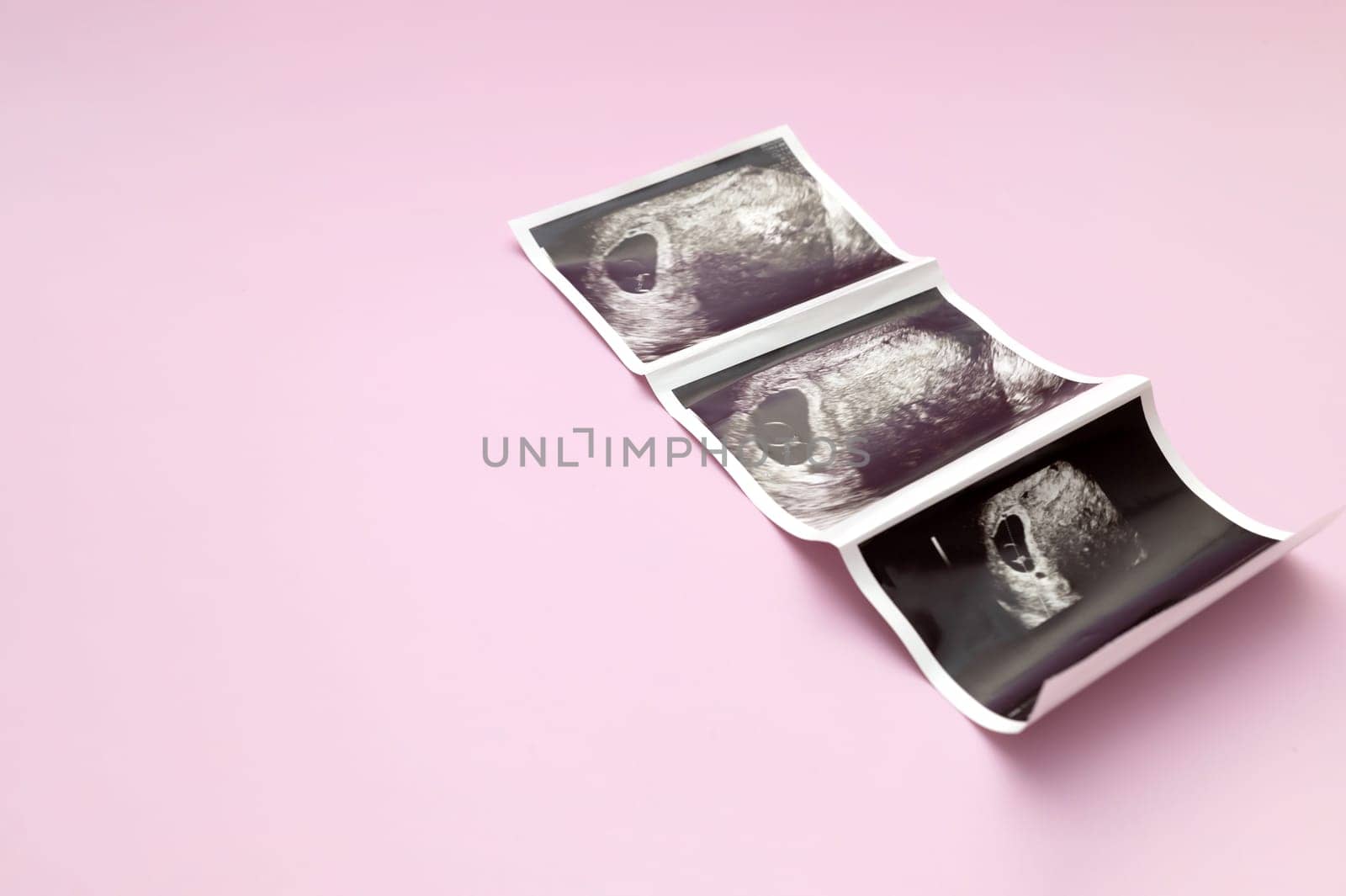 Ultrasound Image, Picture Of 7 Weeks Pregnant Woman With Twins, Embryo On Pink Background. Selective Focus. Space For Text, Mockup. Fetus Development, Pregnancy Health Checking. Maternity, Horizontal by netatsi