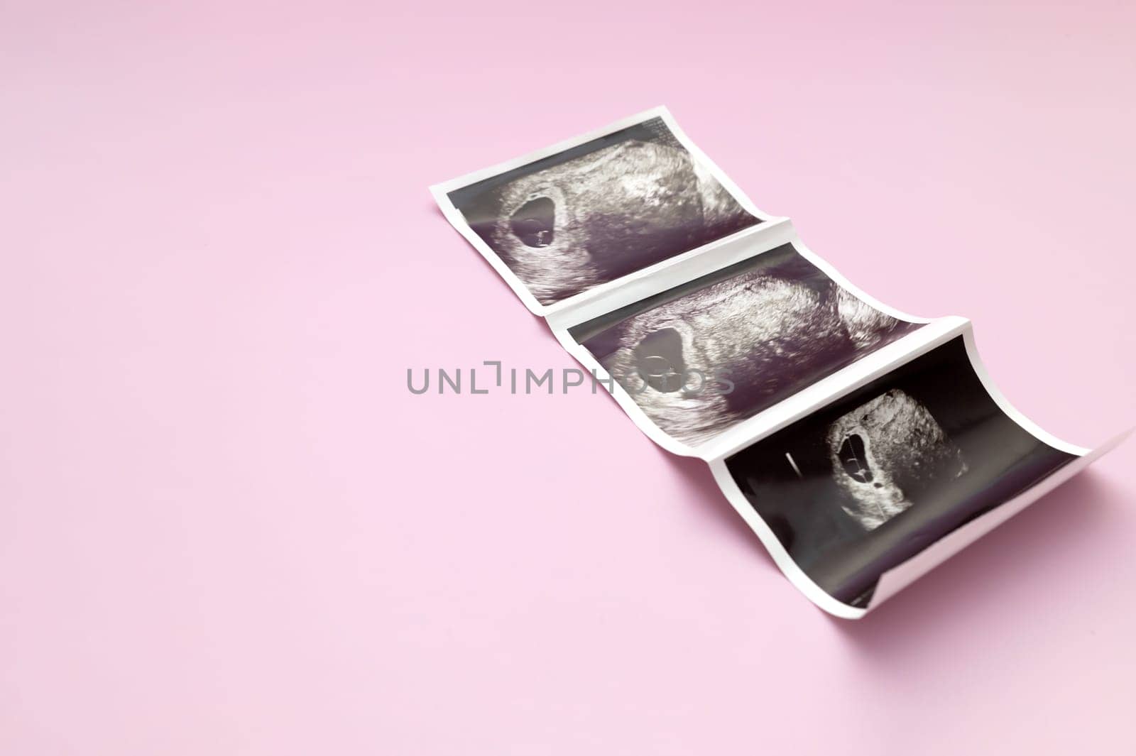 Ultrasound Image, Picture Of 7 Weeks Pregnant Woman With Twins, Embryo On Pink Background. Selective Focus. Space For Text, Mockup. Fetus Development, Pregnancy Health Checking. Maternity, Horizontal.