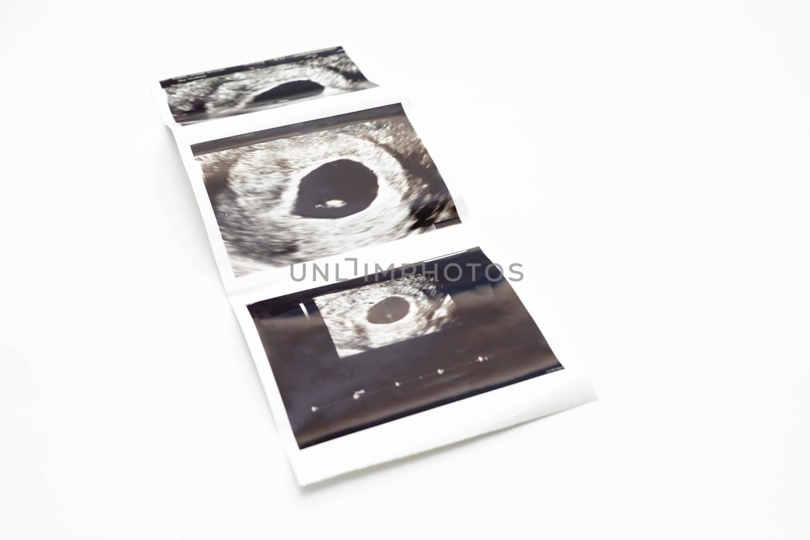 Ultrasound Picture Of 6 Weeks Fetus of Pregnant Woman, Embryo Image On White Background. Selective Focus. Fetus Development, Pregnancy Health Checking. Maternity, Horizontal Plane