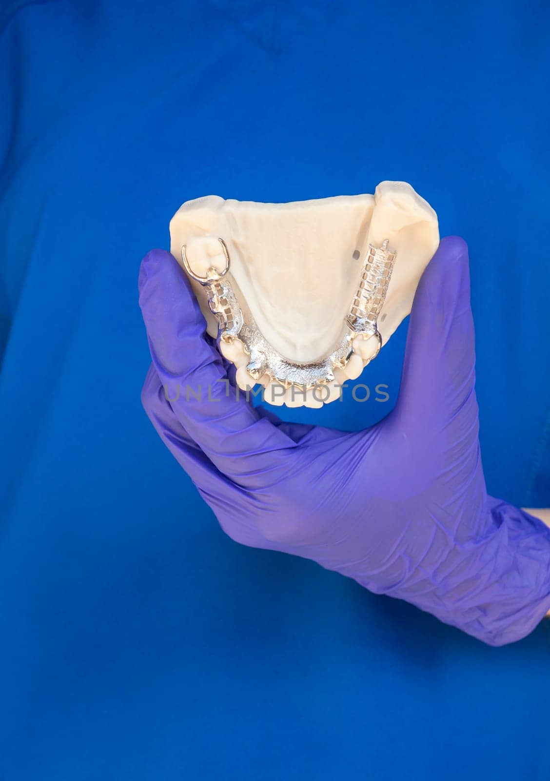 Dentist Holding Metal Frame Lower Partial Denture with Die Stone, Plaster Cast Molds Of Lower Jaws, Cobalt Chrome Dental Plate, 3D Printed Bridge. Vertical Plane by netatsi