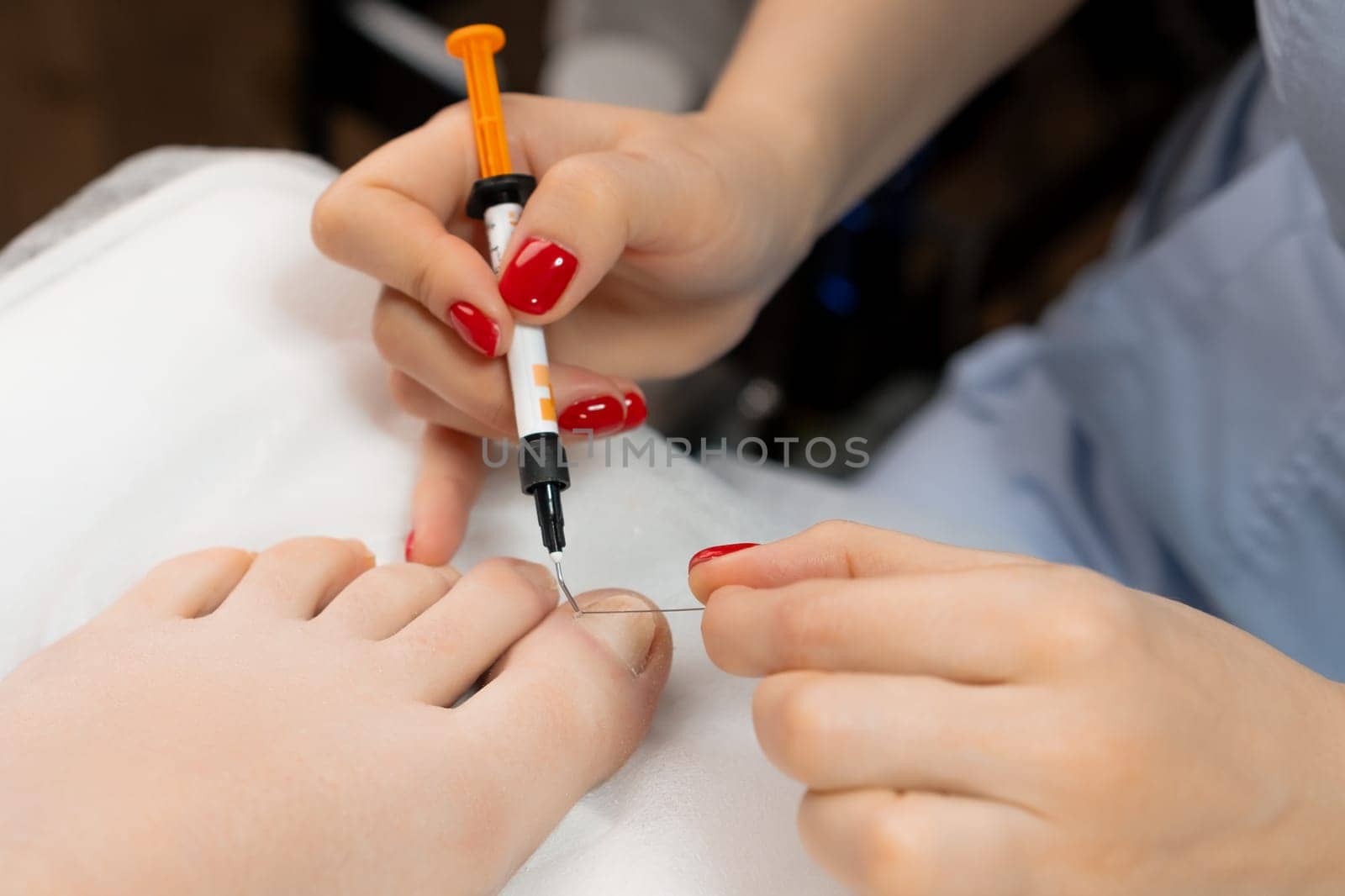 Podologist sets titanium toenail braces for woman by vladimka