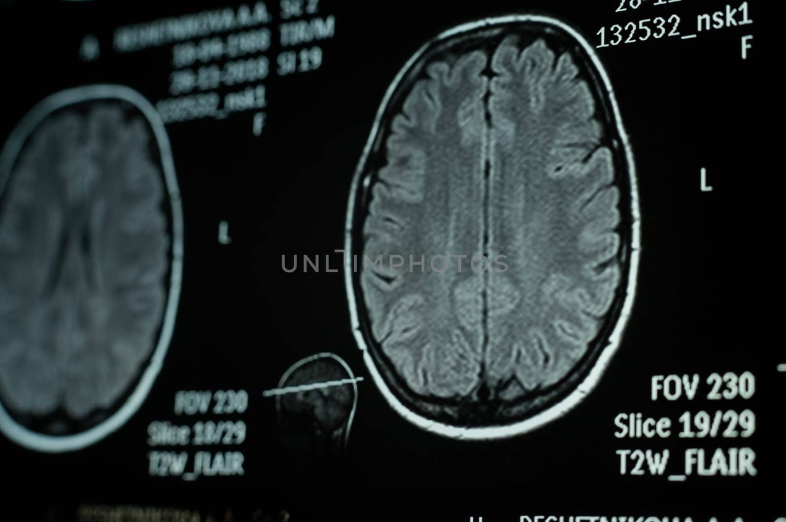 Close-up of magnetic resonance imaging of the human brain.