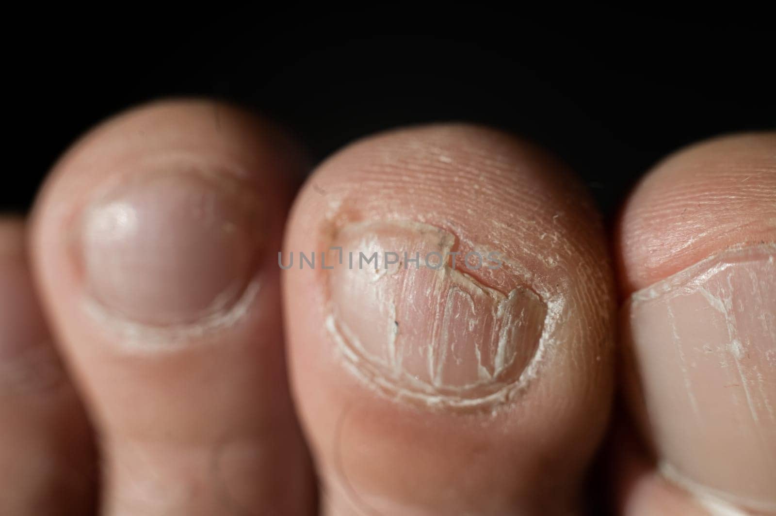 Close-up of male toes with a cracked nail.