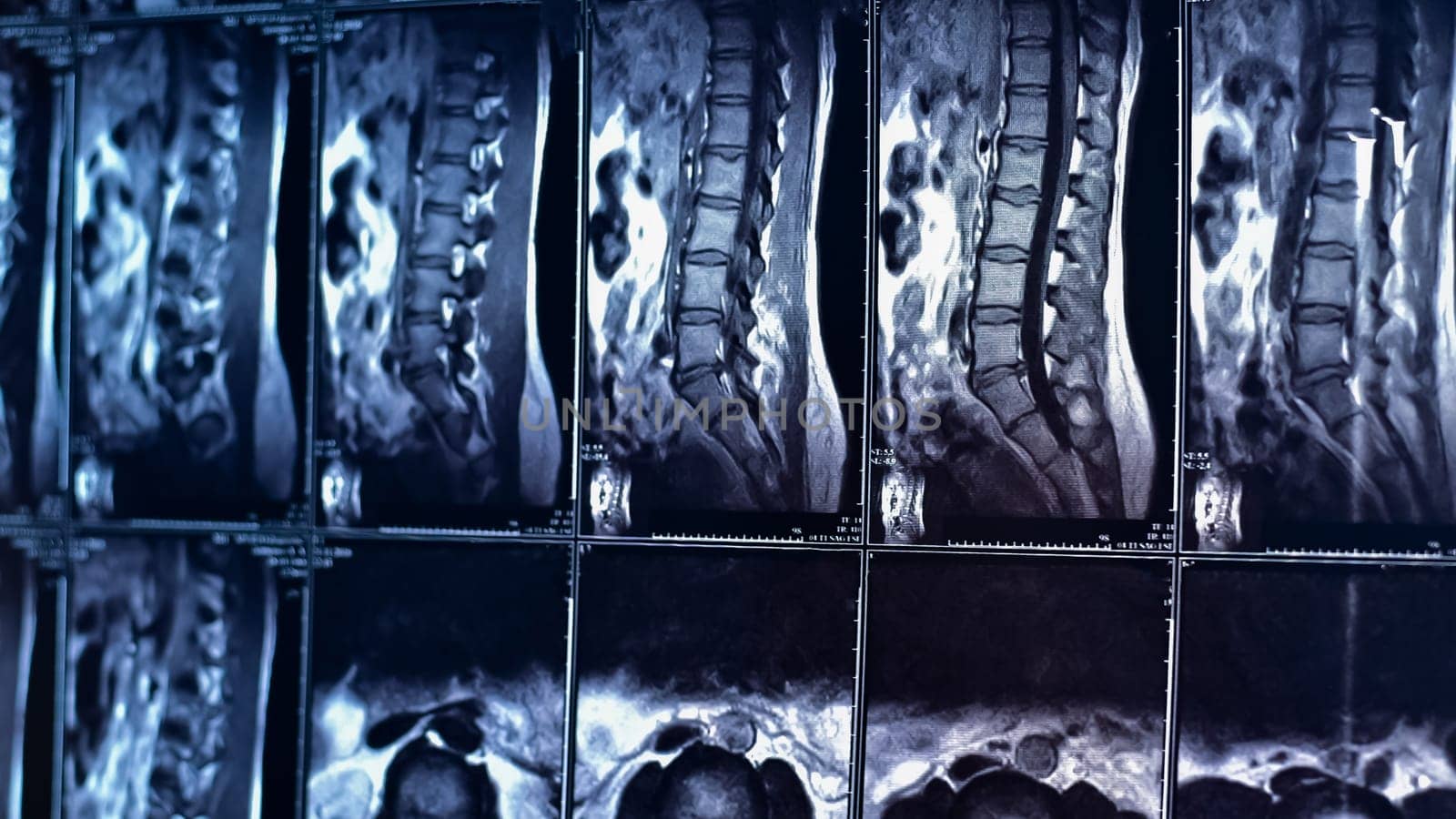 Magnetic resonance imaging of the lumbar spine