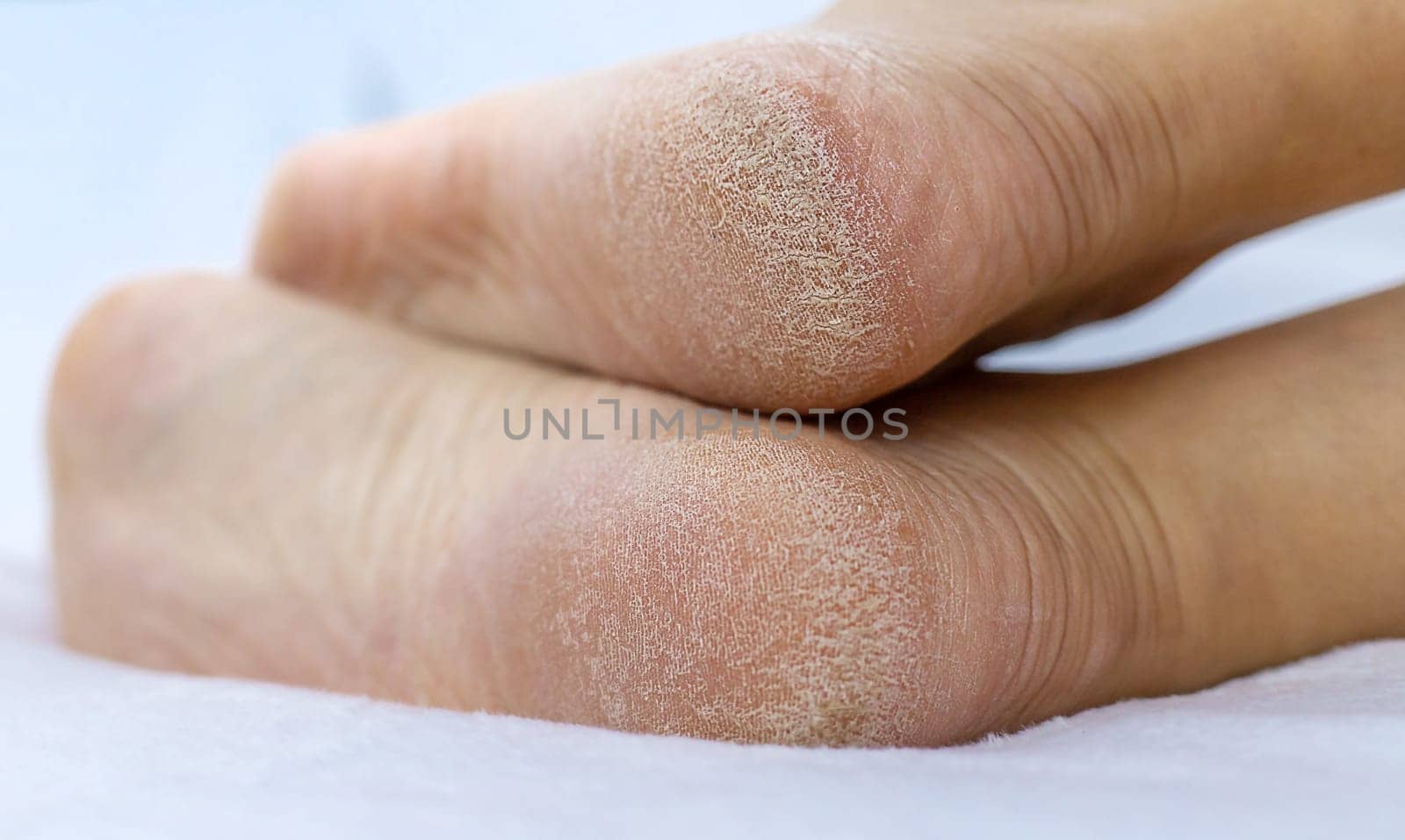 Female feet dry skin on the heels. Selective focus. People.