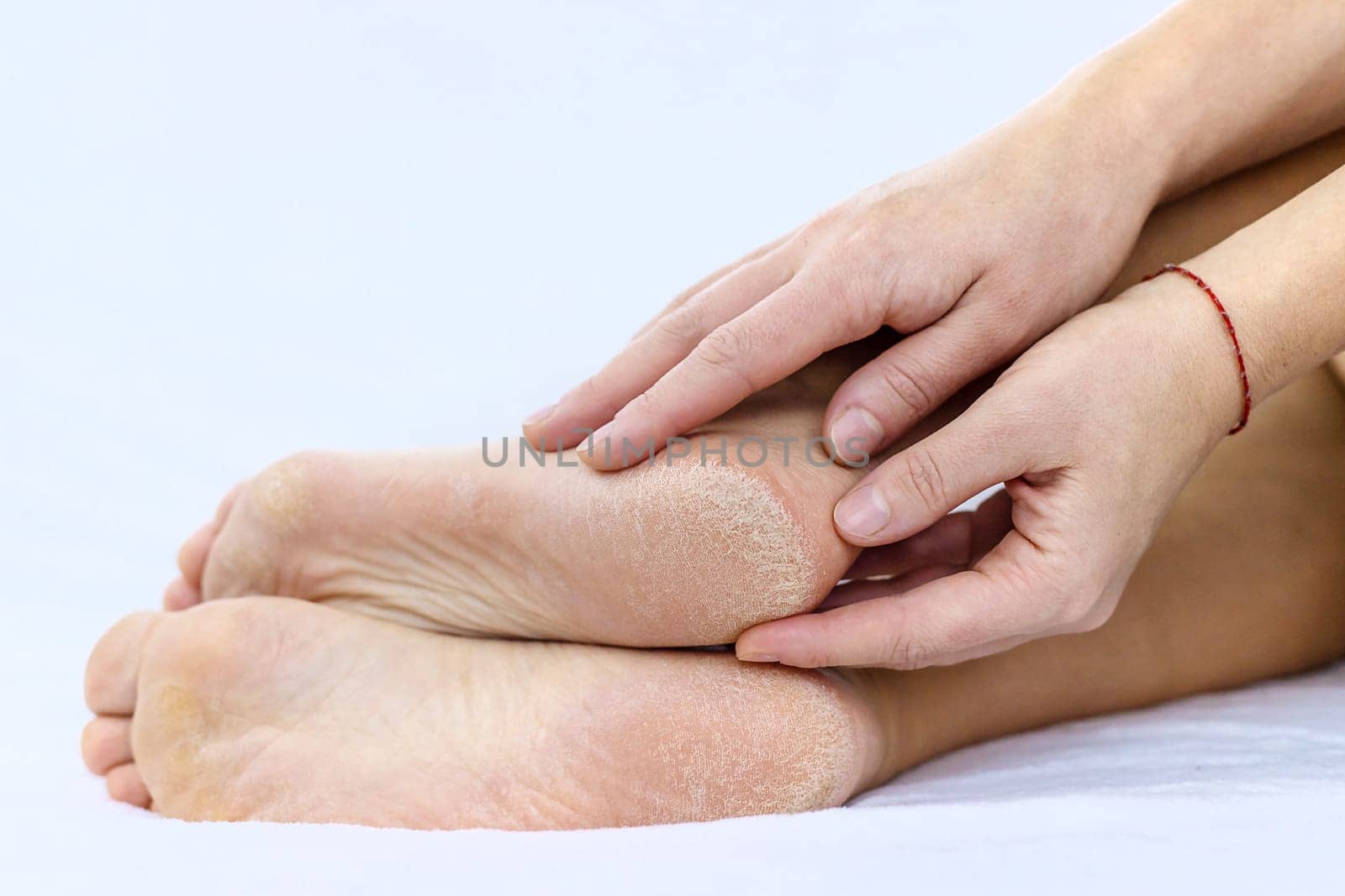 Female feet dry skin on the heels. Selective focus. People.