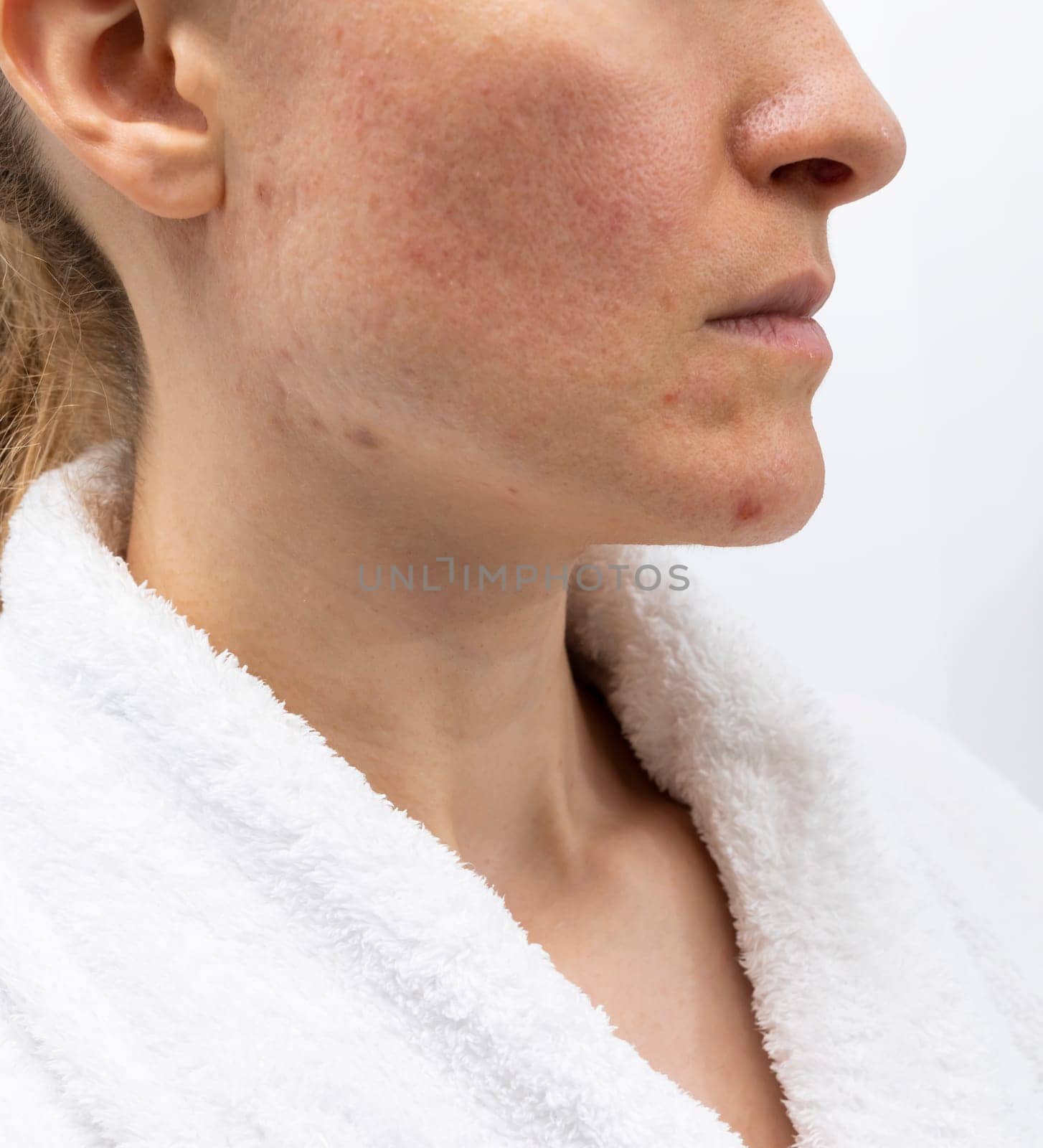 Closeup Face of Woman in her 30s with Acne Problem, Couperosis, Scarring, Blackheads. Vertical Plane, Adult Skin Problem. Cosmetics and Healthcare, Beauty Concept. Rosacea. by netatsi