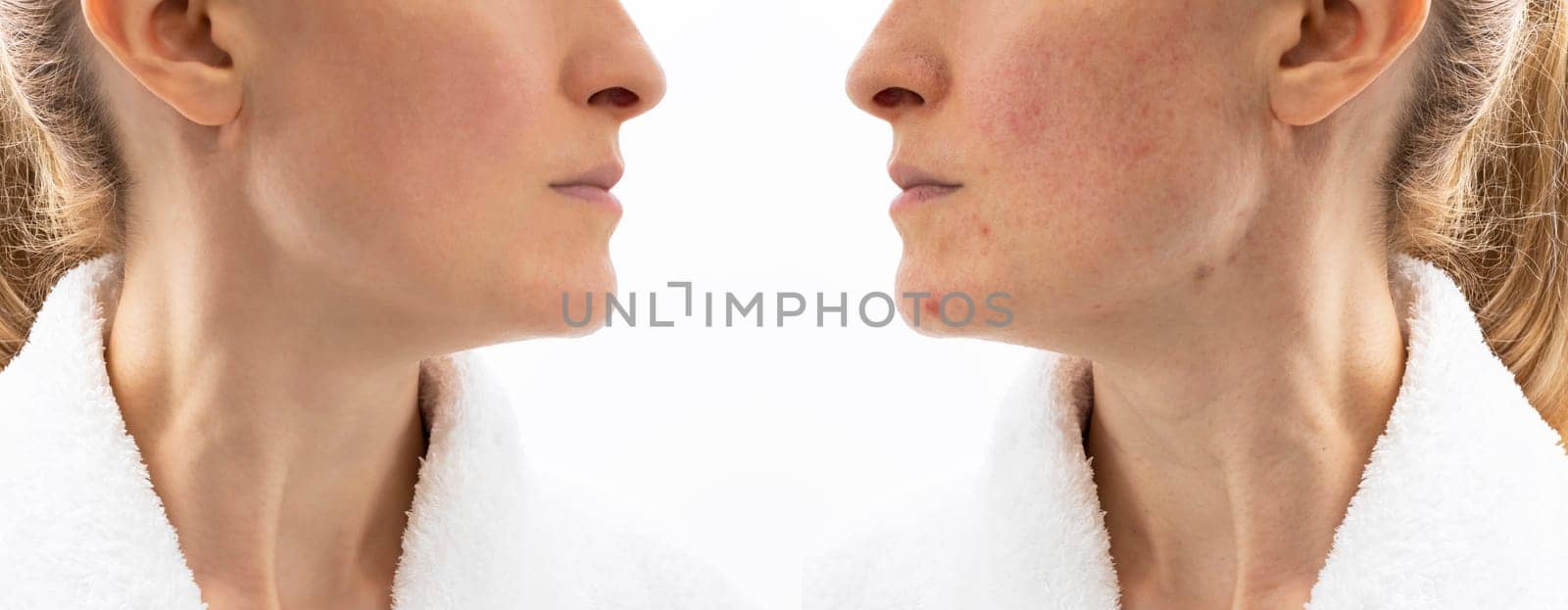 Before and After Skin Acne Treatment. Face of Woman in her 30s with Acne Problem, Couperosis, Scarring, Blackheads. Adult Skin Problem. Cosmetics and Healthcare, Beauty Concept. Rosacea. Horizontal by netatsi