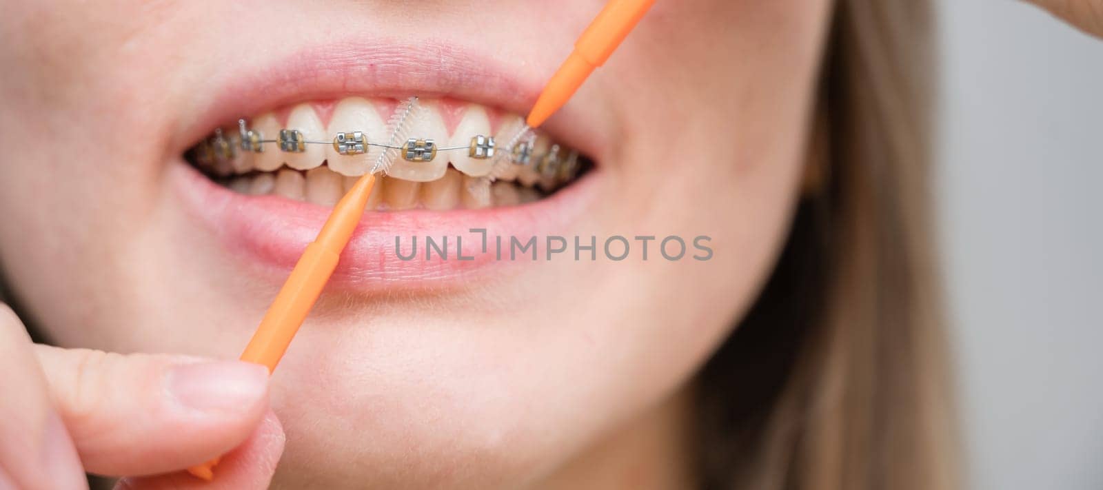 Unrecognizable Caucasian woman cleans braces with a brush. Close-up of female teeth with brackets.