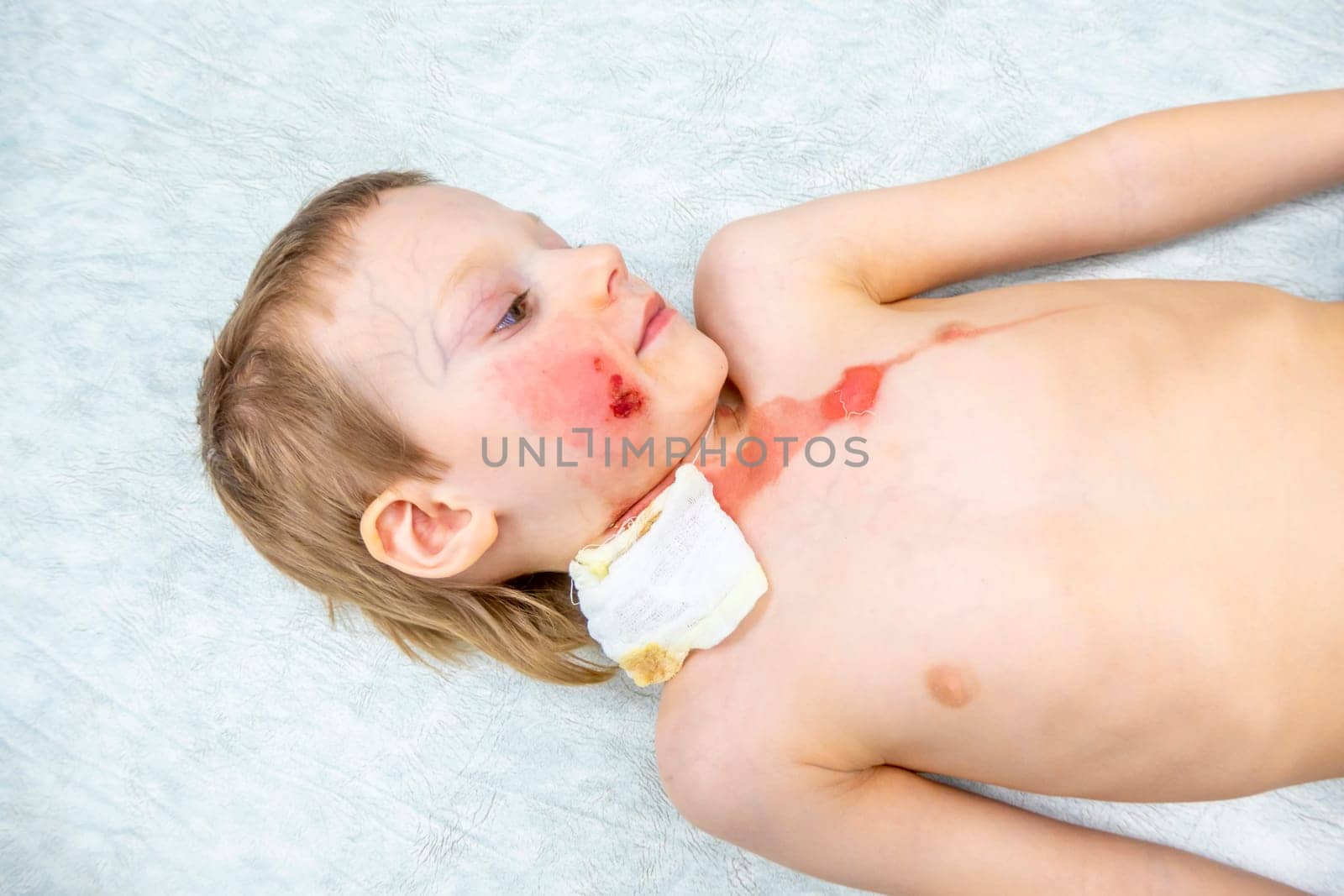 medical procedure dressing a boy with a first-degree burn from boiling water on his face, neck and chest