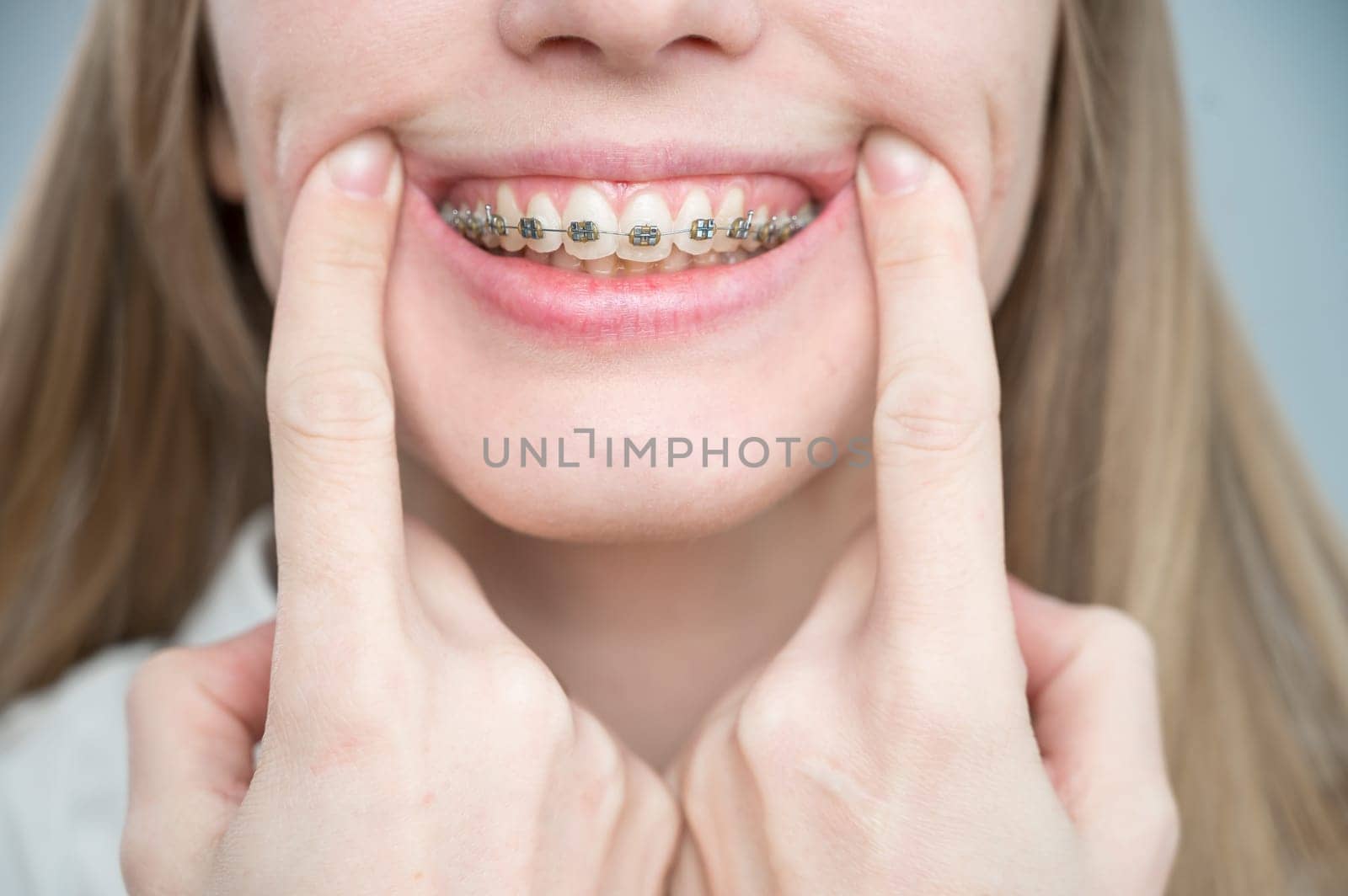 Close-up of a young woman's smile with metal braces on her teeth. Correction of bite.