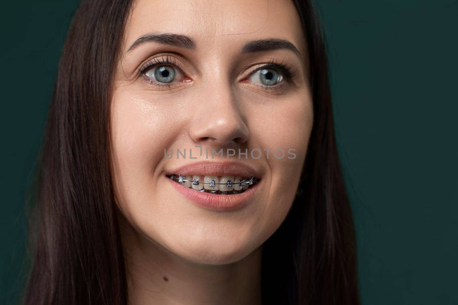 A woman with braces on her teeth smiles brightly, showcasing her dental braces. Her teeth appear straight and aligned, contributing to her confident smile.