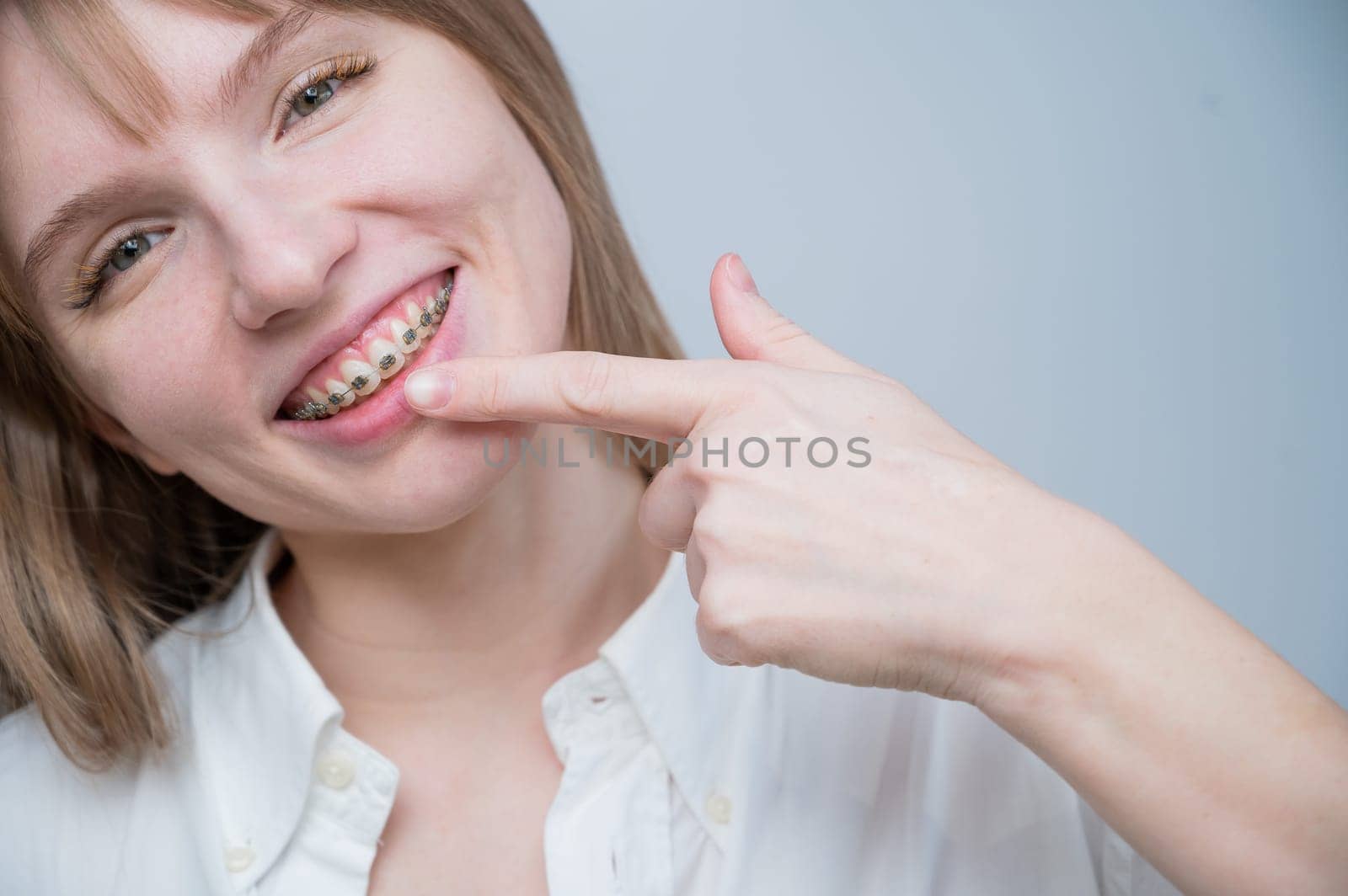 A beautiful red-haired girl smiles and points to the braces. Young woman corrects bite with orthodontic appliance.