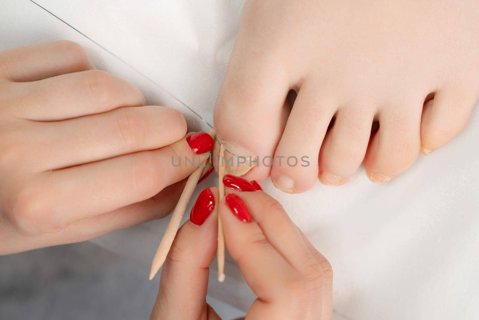 Podiatrist attaches a titanium thread to a toenail for woman, top view.