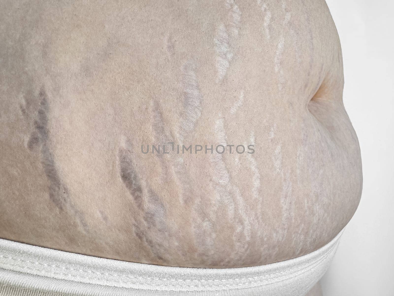 Close up of stretch marks on womans skin, highlighting natural beauty and the concept postpartum changes. High quality photo