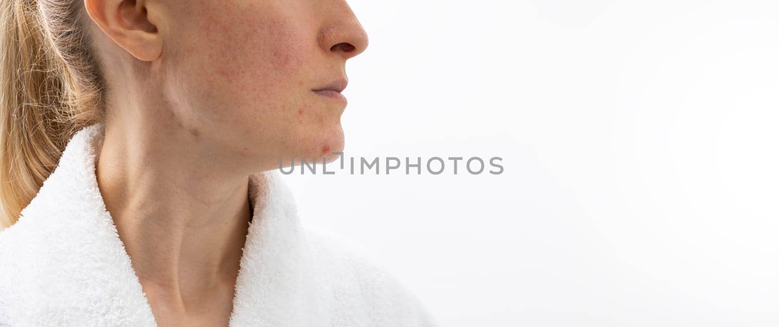 Design Cropped Face of Woman in her 30s with Acne Problem, Couperosis, Scarring, Blackheads. Horizontal Plane. Copy Space. Adult Skin Problem. Cosmetics and Healthcare, Beauty Concept. Rosacea