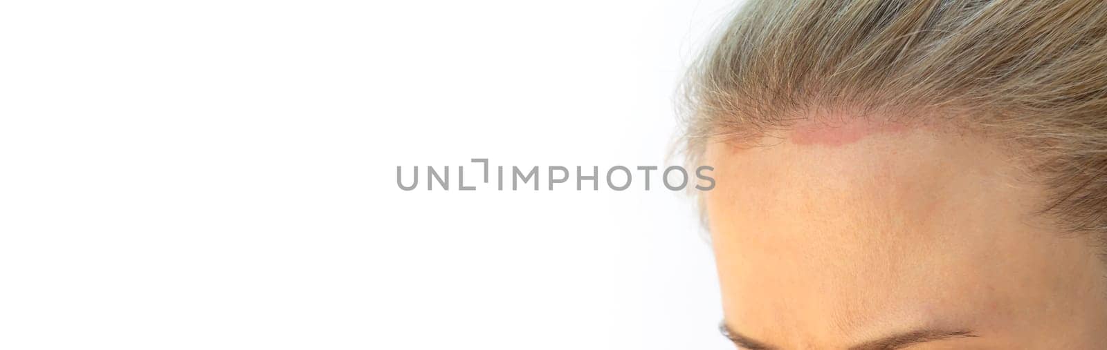 Banner Cropped Caucasian Female Face with Sunburn Skin On Scalp, Forehead Under Hair, White Background, Copy Space. White Woman Suffers From Face Sun Burn. UV Danger. Horizontal Plane.