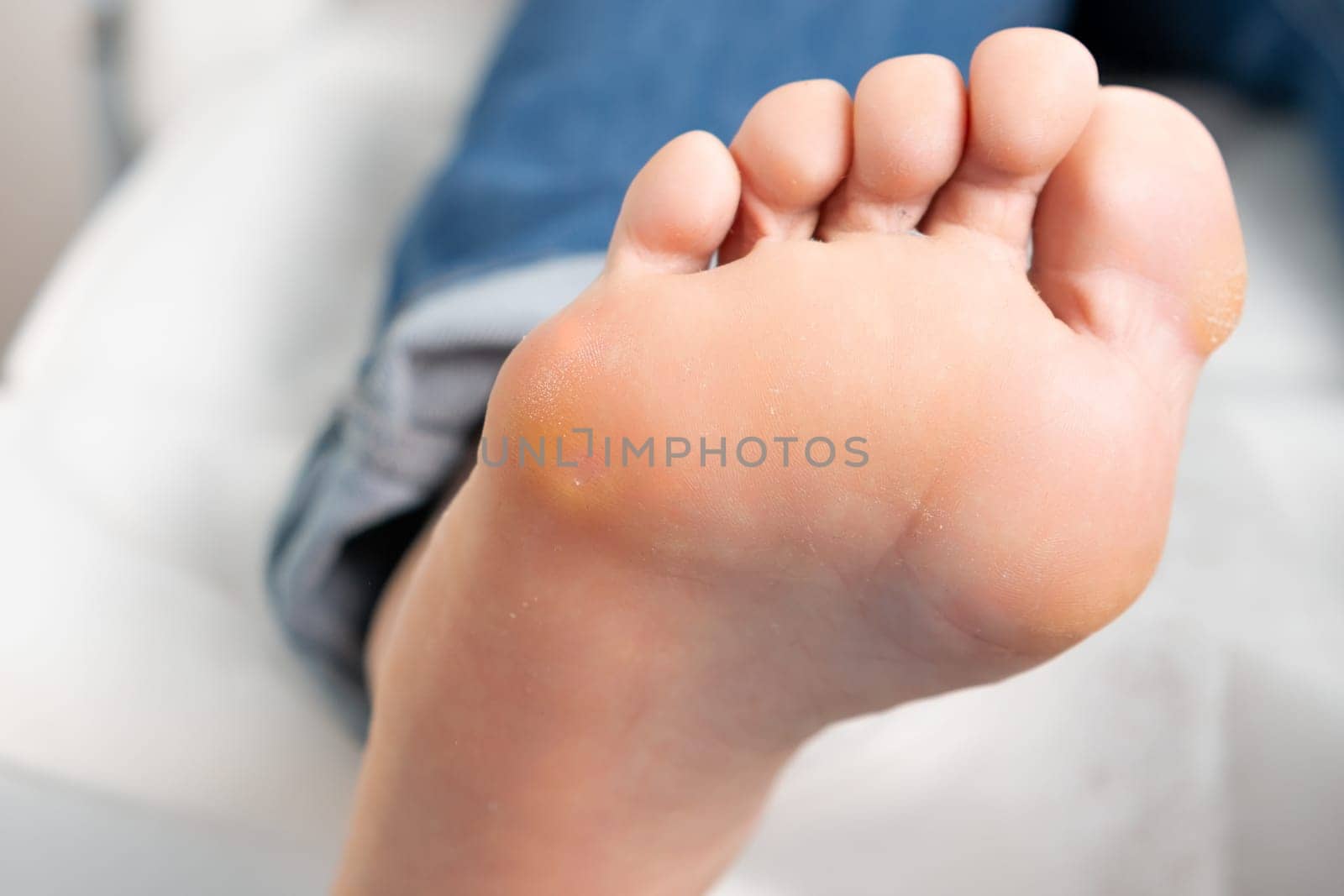 Close up woman foot with a callus laying on a couch in a medical center.