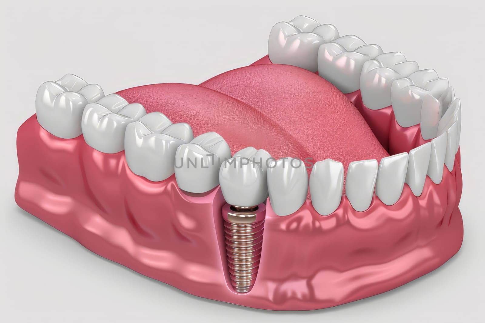 Dental implantation, teeth with implant screw. ai generative by matamnad