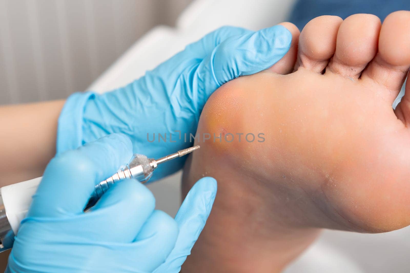 Close up callus removal using electric drill on a womans foot at the medical center