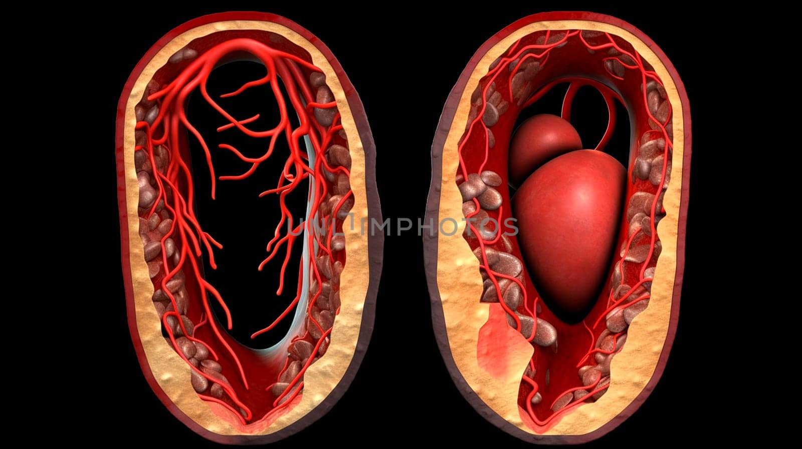 blockage of arteries by cholesterol plaques, artery with blood flow obstructed by cholesterol. Generative AI, Red.