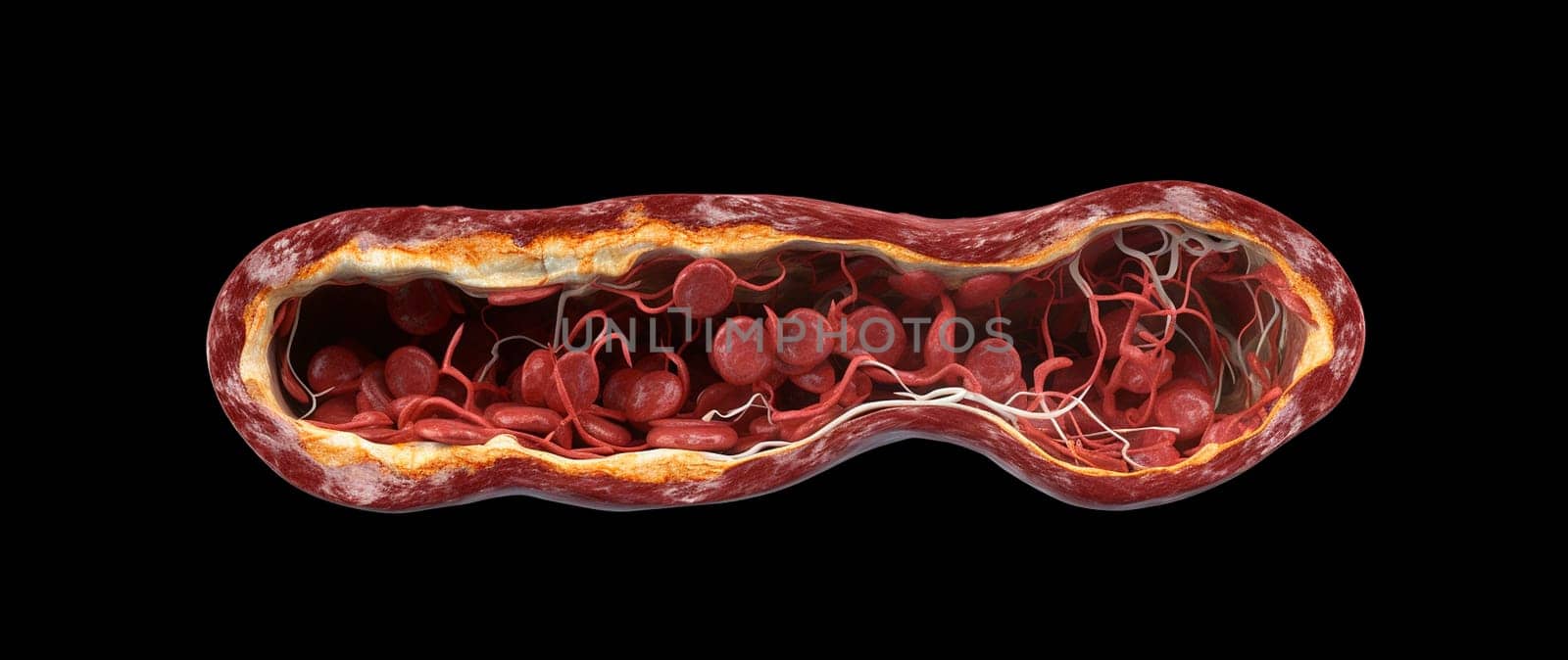 blockage of arteries by cholesterol plaques, artery with blood flow obstructed by cholesterol. Generative AI, Red.