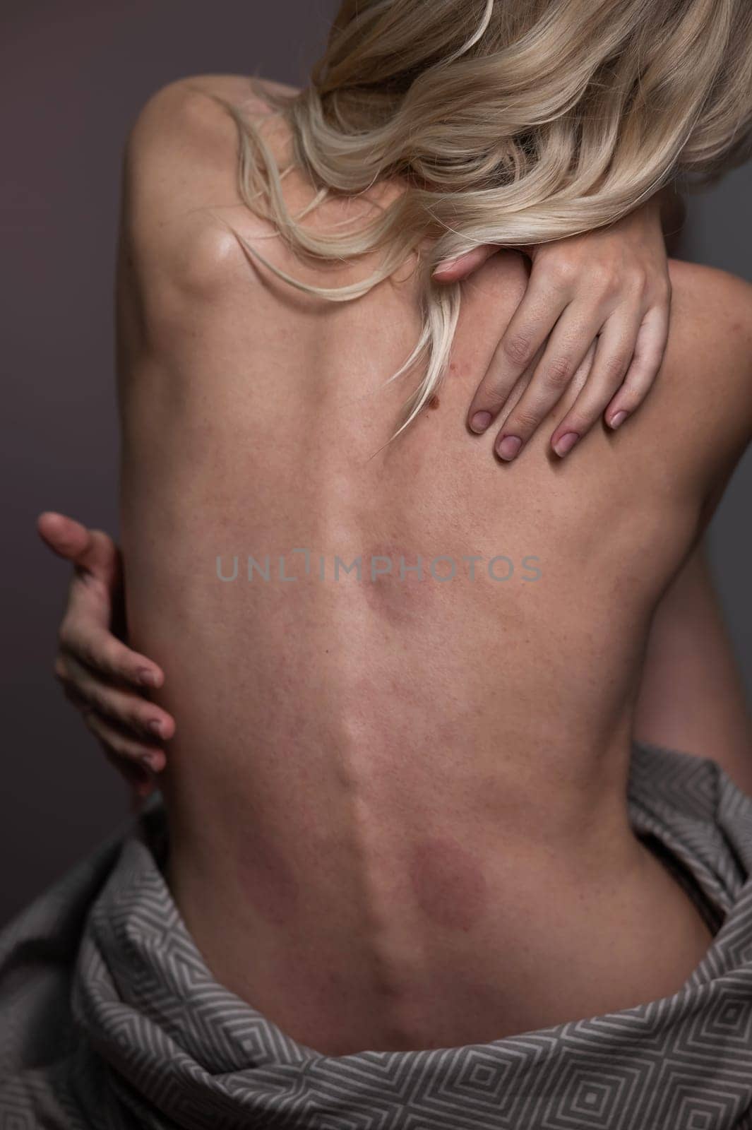 Caucasian woman after back massage with vacuum cups. Vertical photo