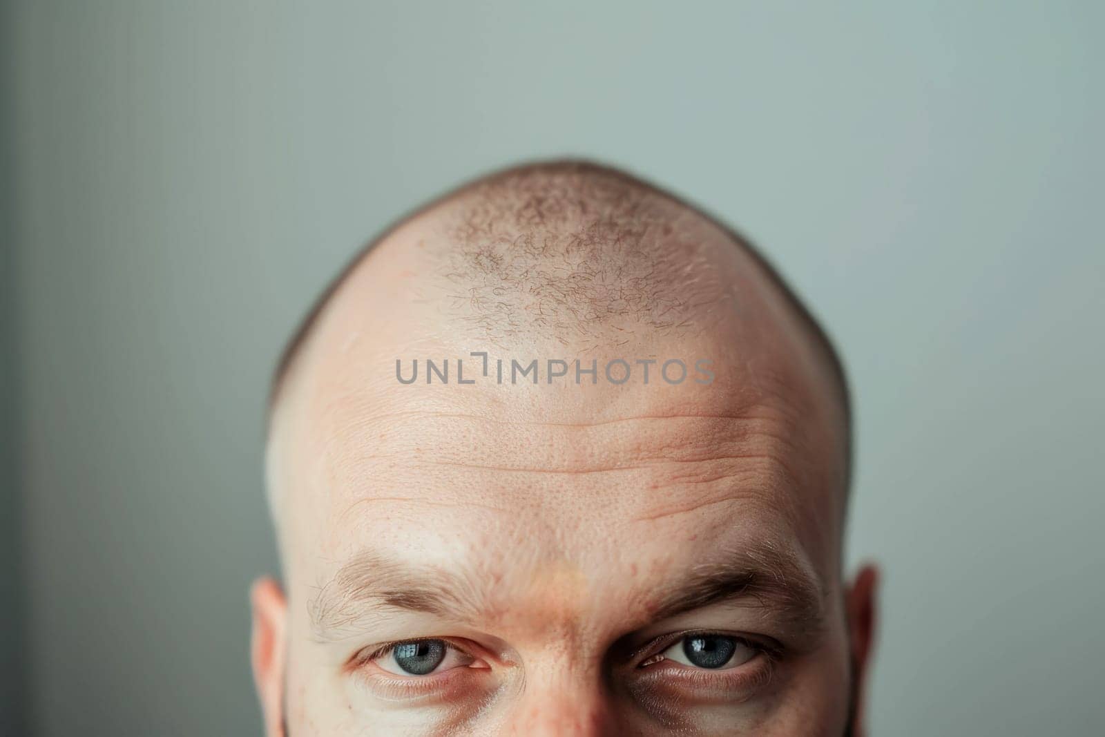 a balding man's head with hair loss problem before treatment on grey background, collage.