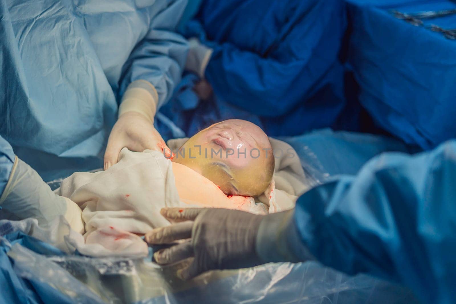 A baby is delivered in an intact amniotic sac during a caesarean section. The medical team carefully performs the procedure, highlighting the precision and care involved in this unique birth scenario by galitskaya