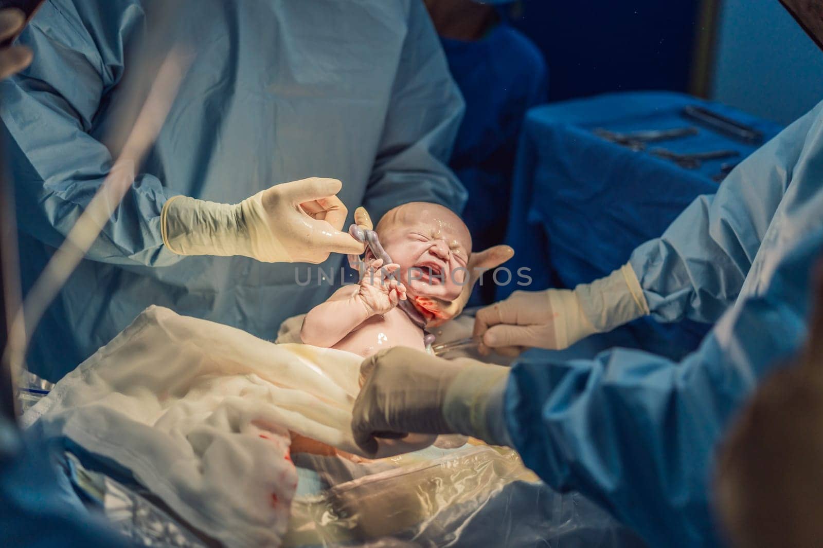 The umbilical cord is visible around the neck of a newborn undergoing cesarean section. This medical moment highlights the intricacies and care involved in childbirth, focusing on the delicate process of ensuring the baby's safety by galitskaya