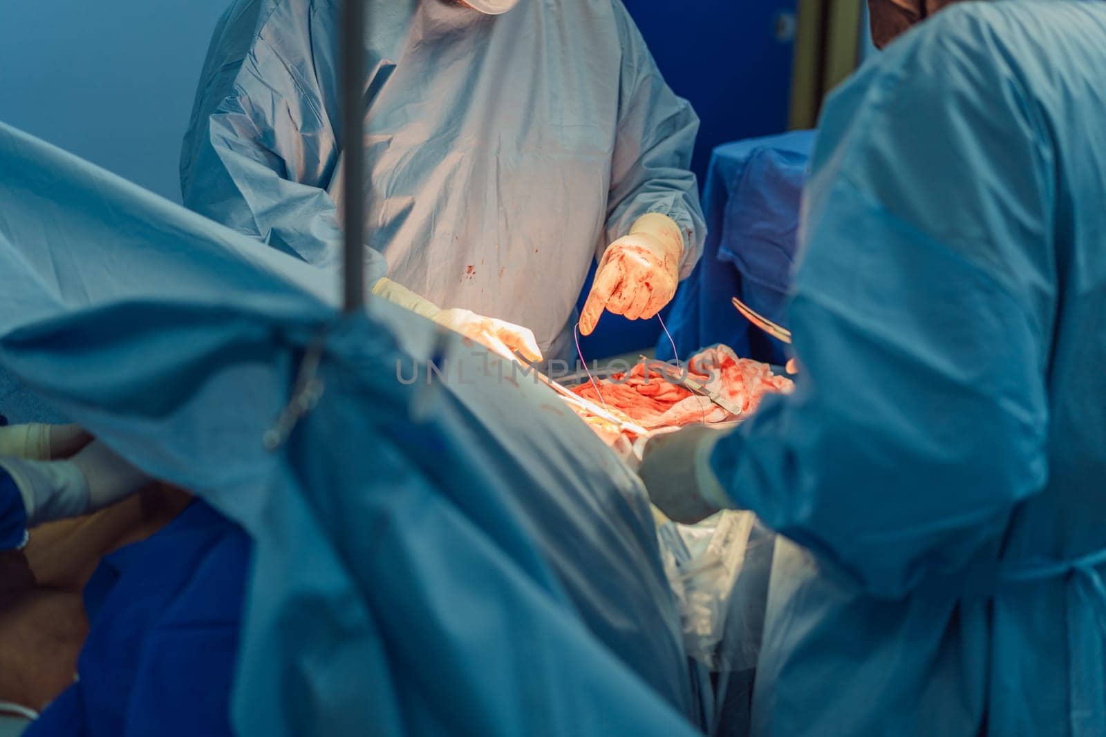 Two doctors performing an operation in the operating room. The surgeons are focused and precise, surrounded by advanced medical equipment. The sterile environment ensures patient safety during the surgical procedure. by galitskaya