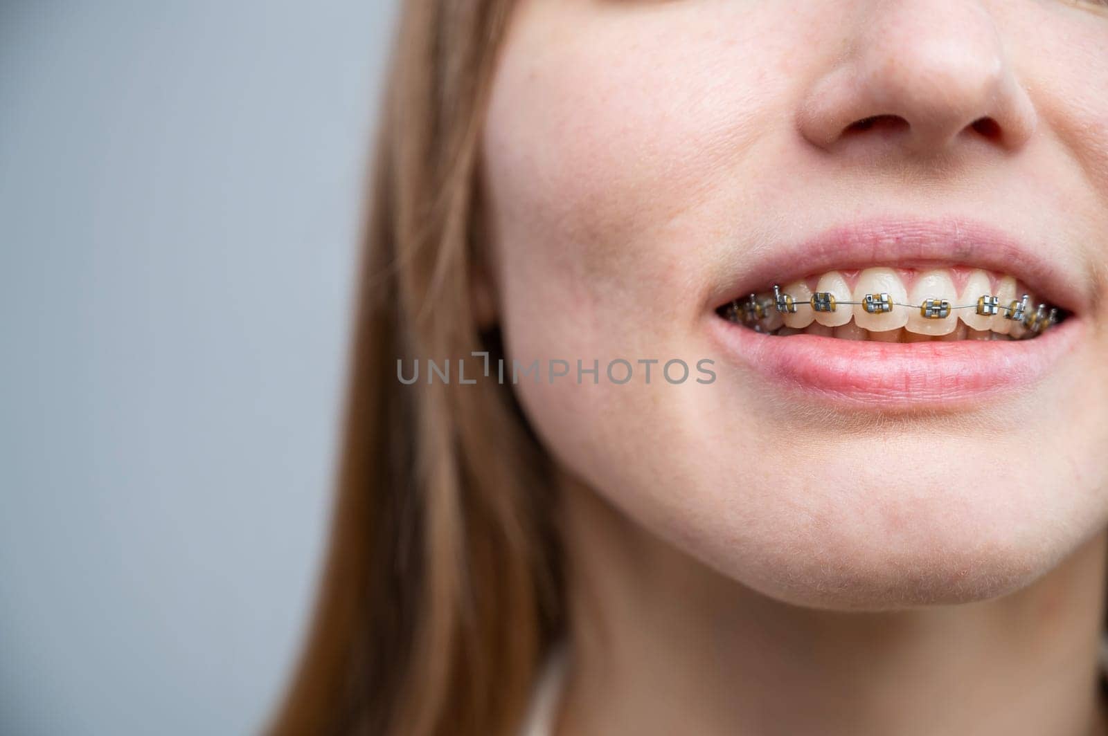 Unrecognizable red-haired girl with braces smiles. Young woman corrects bite with orthodontic appliance