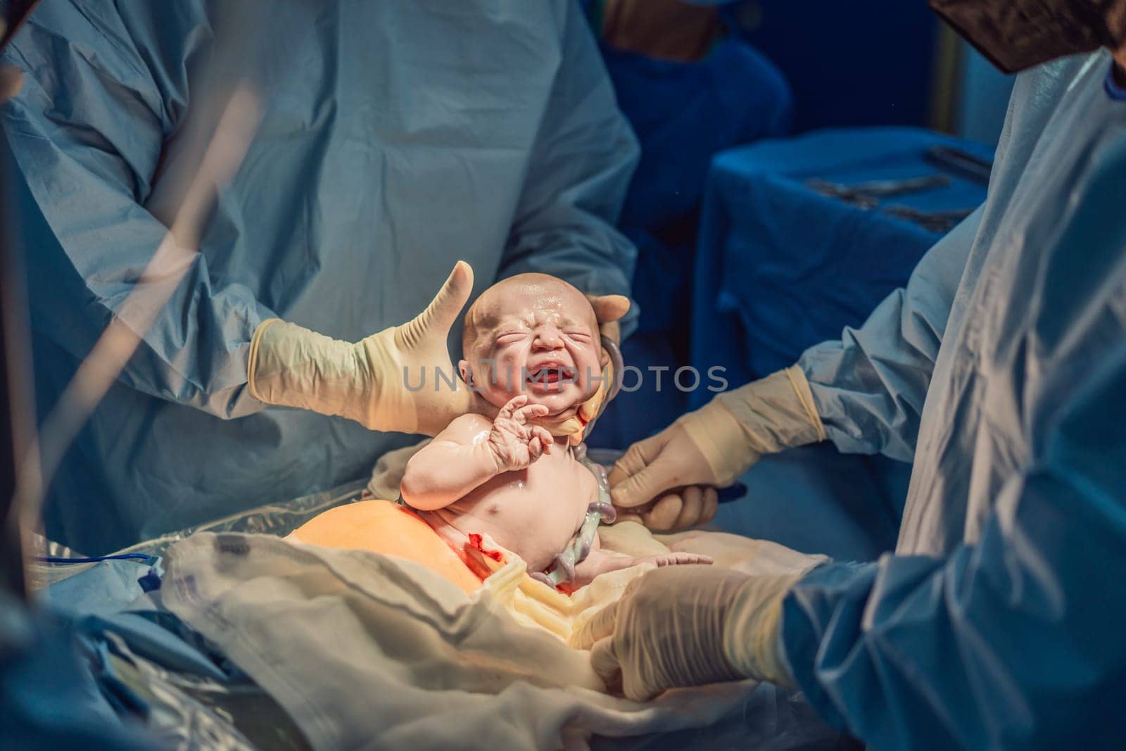 A baby is delivered during a caesarean section. The surgical procedure is conducted in a sterile operating room with a skilled medical team, ensuring the safety and health of both mother and baby.
