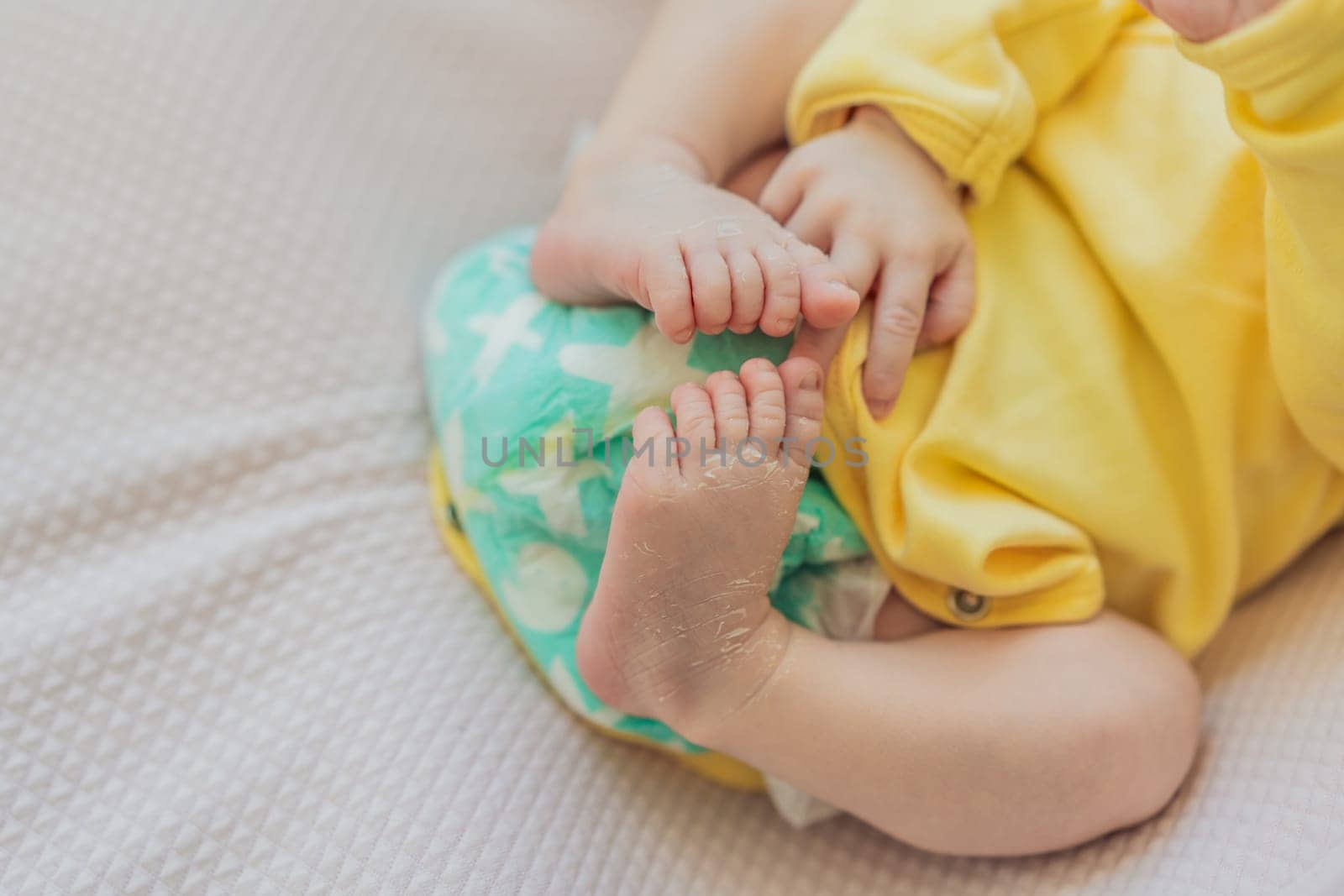 The newborn's skin is peeling. Mom uses skin products and massages to care for and soothe the baby's delicate skin, ensuring comfort and promoting healthy skin.