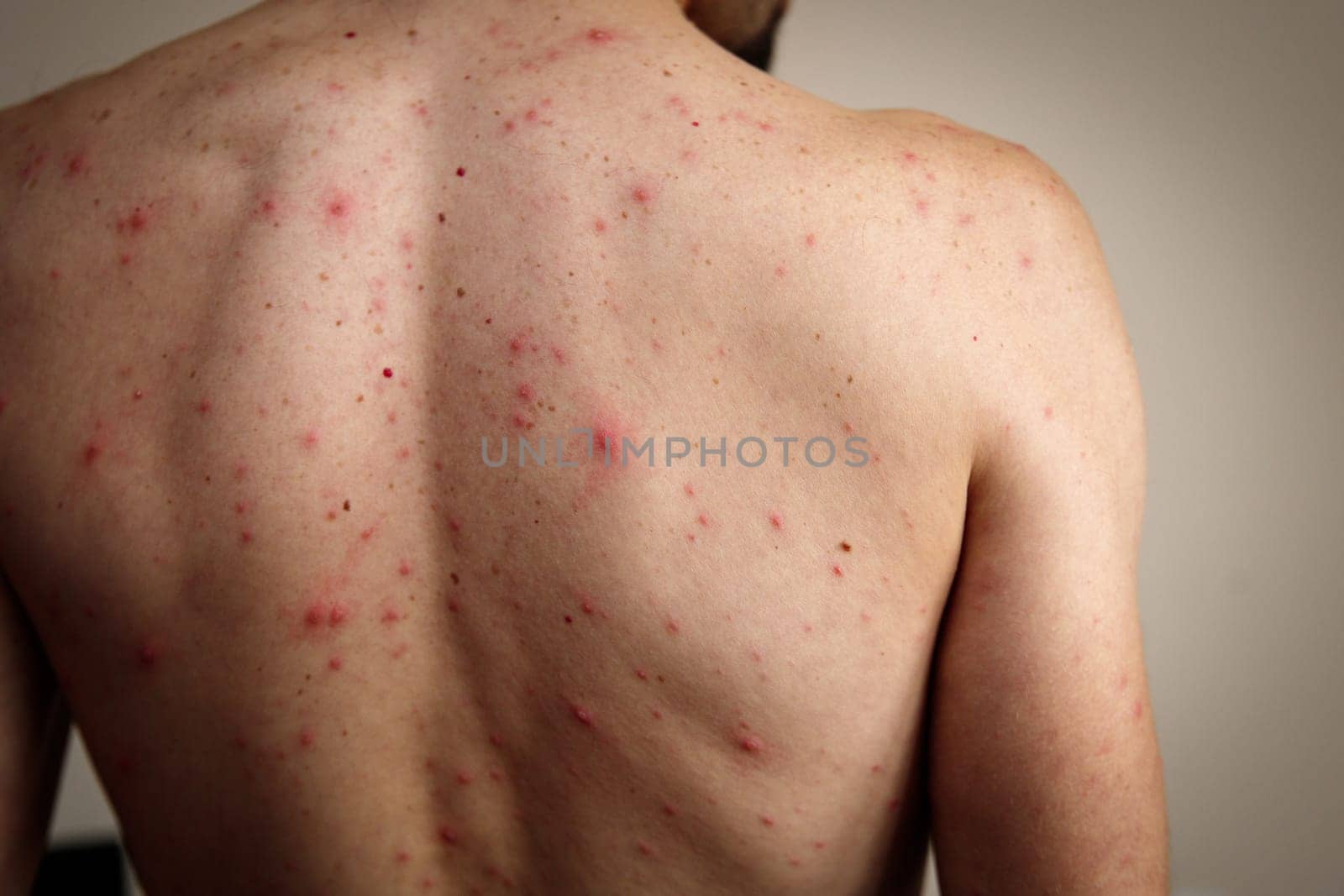 A rash of red dots and blisters on a man's back. Chickenpox is much more severe in adults.