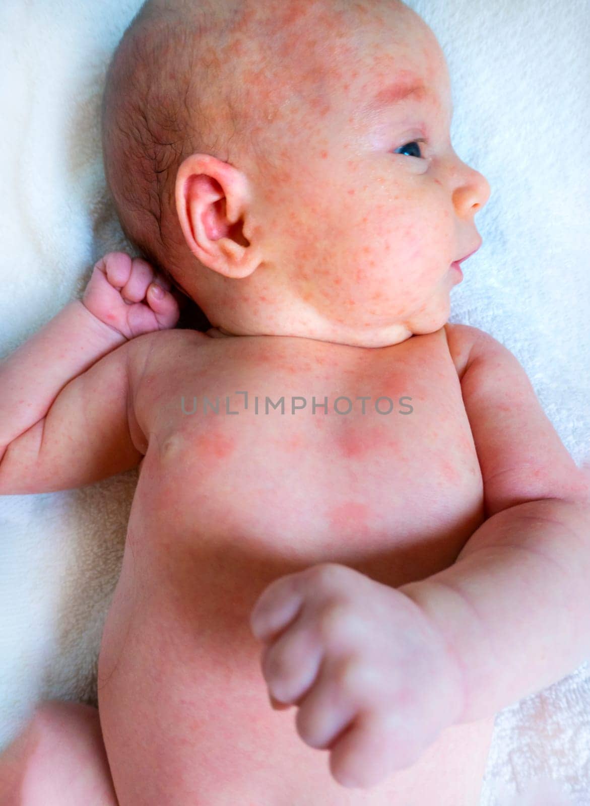 baby allergy skin. child dermatitis symptom problem rash. suffering atopic symptom on skin cheeks. concept child health. allergic reaction miliaria, prickly heat on baby's back.