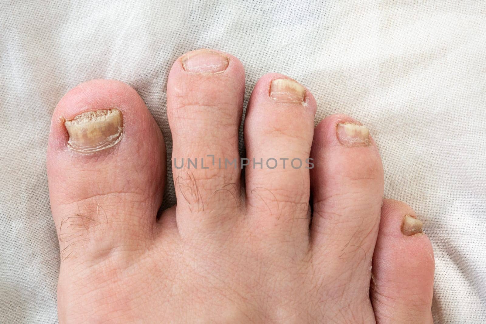 Part of a man's foot with nails affected by fungus, top view.