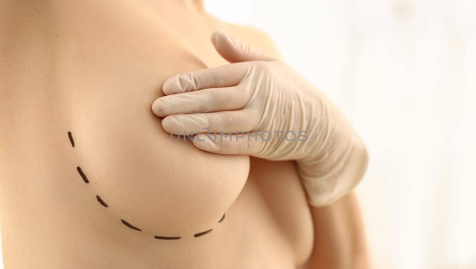 Close-up of woman close nipple with hand, linear marking on boob, cosmetic surgery operation. Patient prepare for beauty procedure. Plastic surgery concept