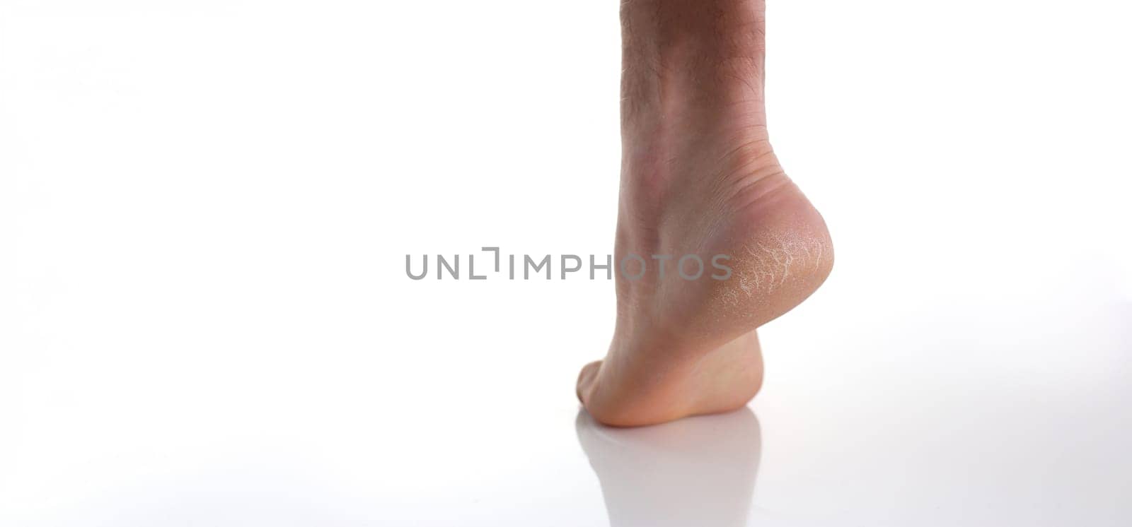 Close-up of heel of foot with bad skin, covered with cracks, use medical treatment, moisturizing cream or peeling. Unhealthy, dermatology problem concept