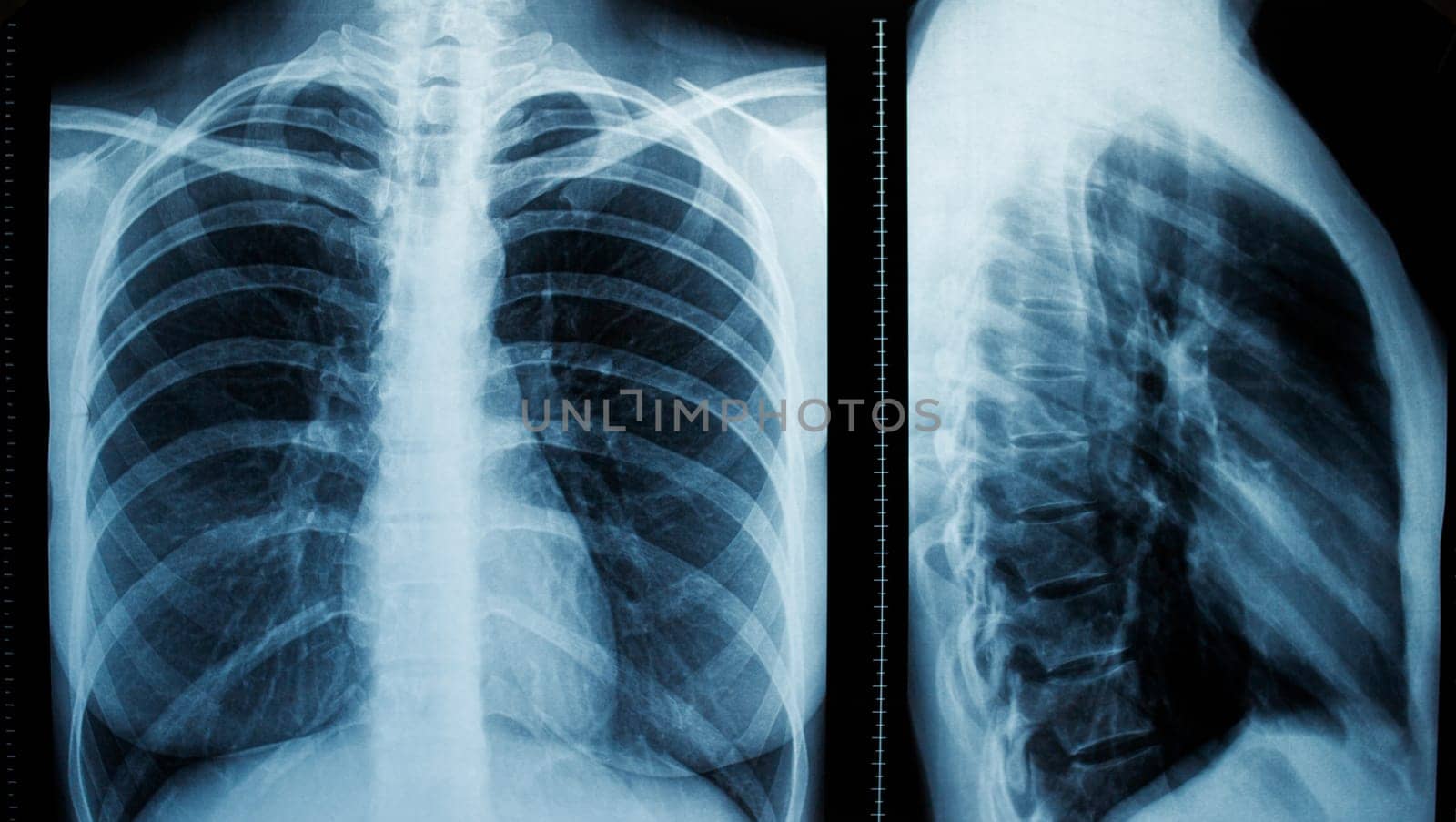 Frontal and lateral projections of a female chest x-ray.