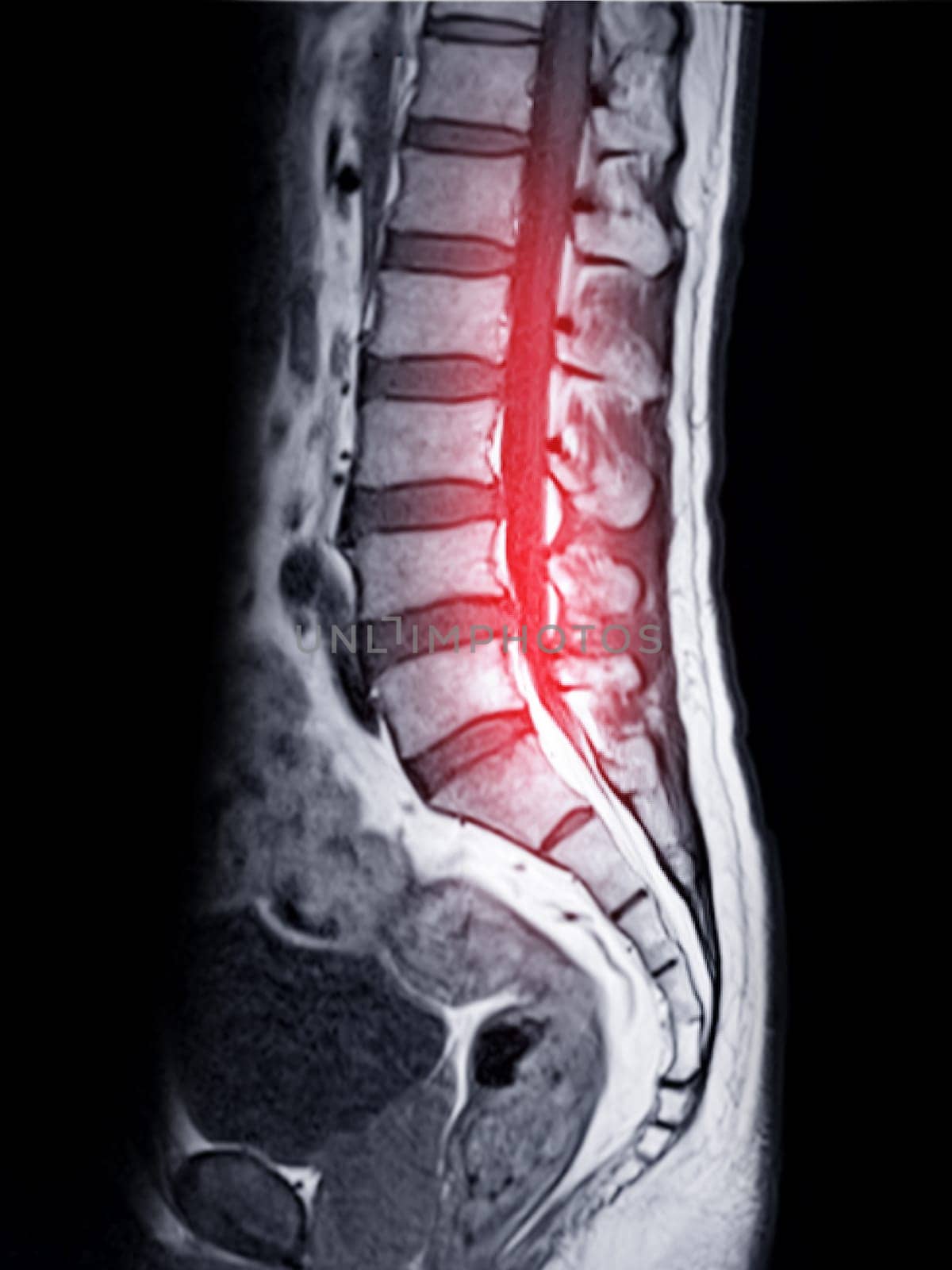 MRI L-S spine or lumbar spine Sagittall T1W view  for diagnosis spinal cord compression.