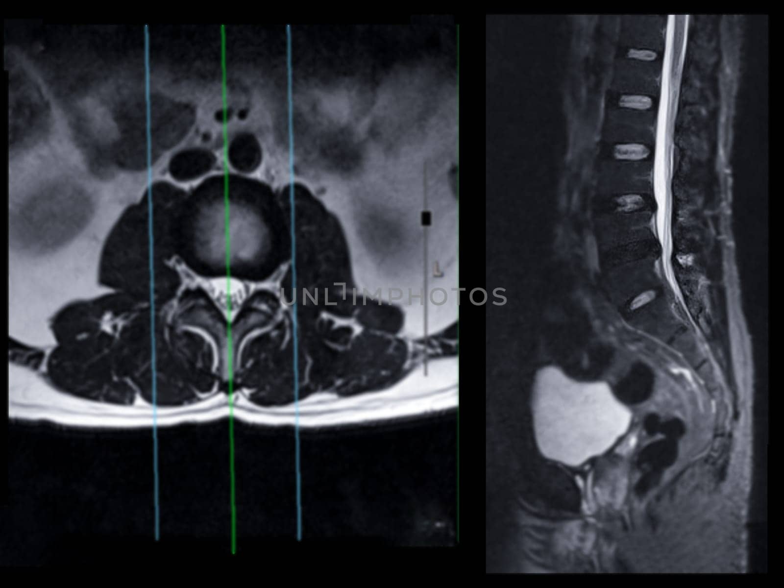 MRI L-S spine or lumbar spine Axial T2W view with sagittal plane for diagnosis spinal cord compression. by samunella