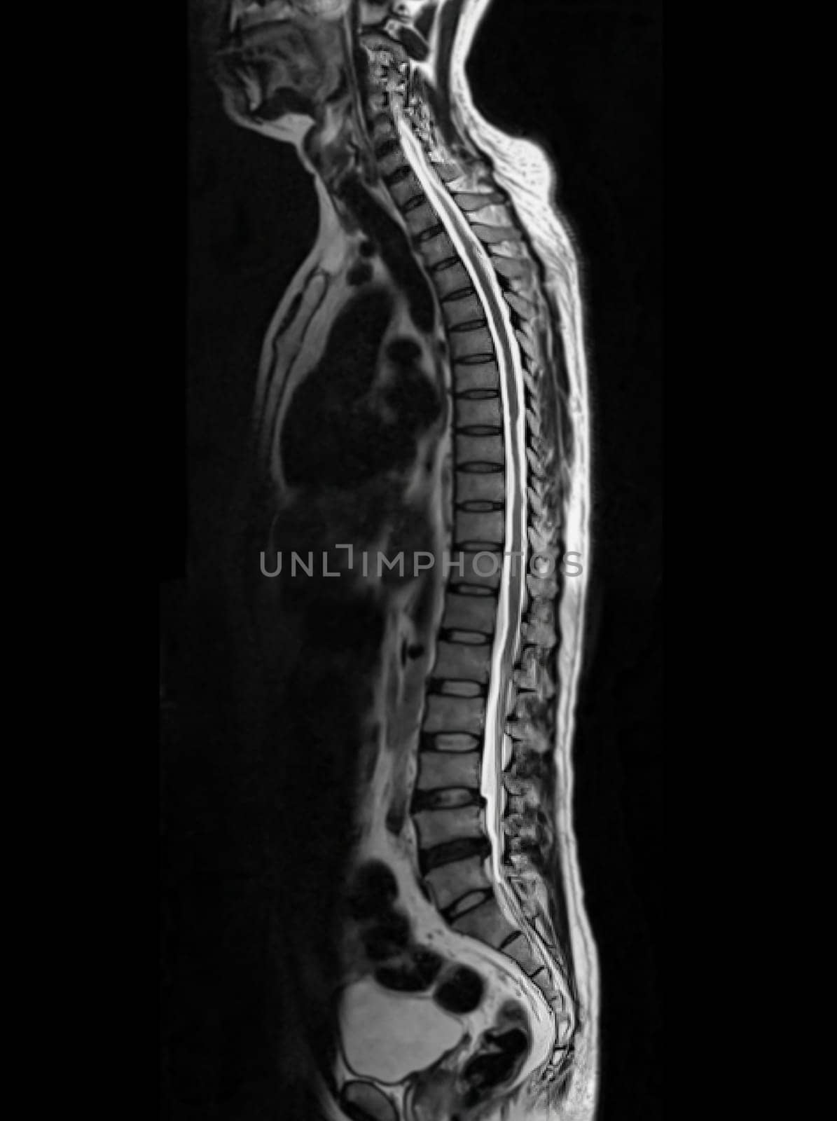 MRI of whole spine  T2W sagittal  plane for diagnostic Spinal Cord Compression. by samunella